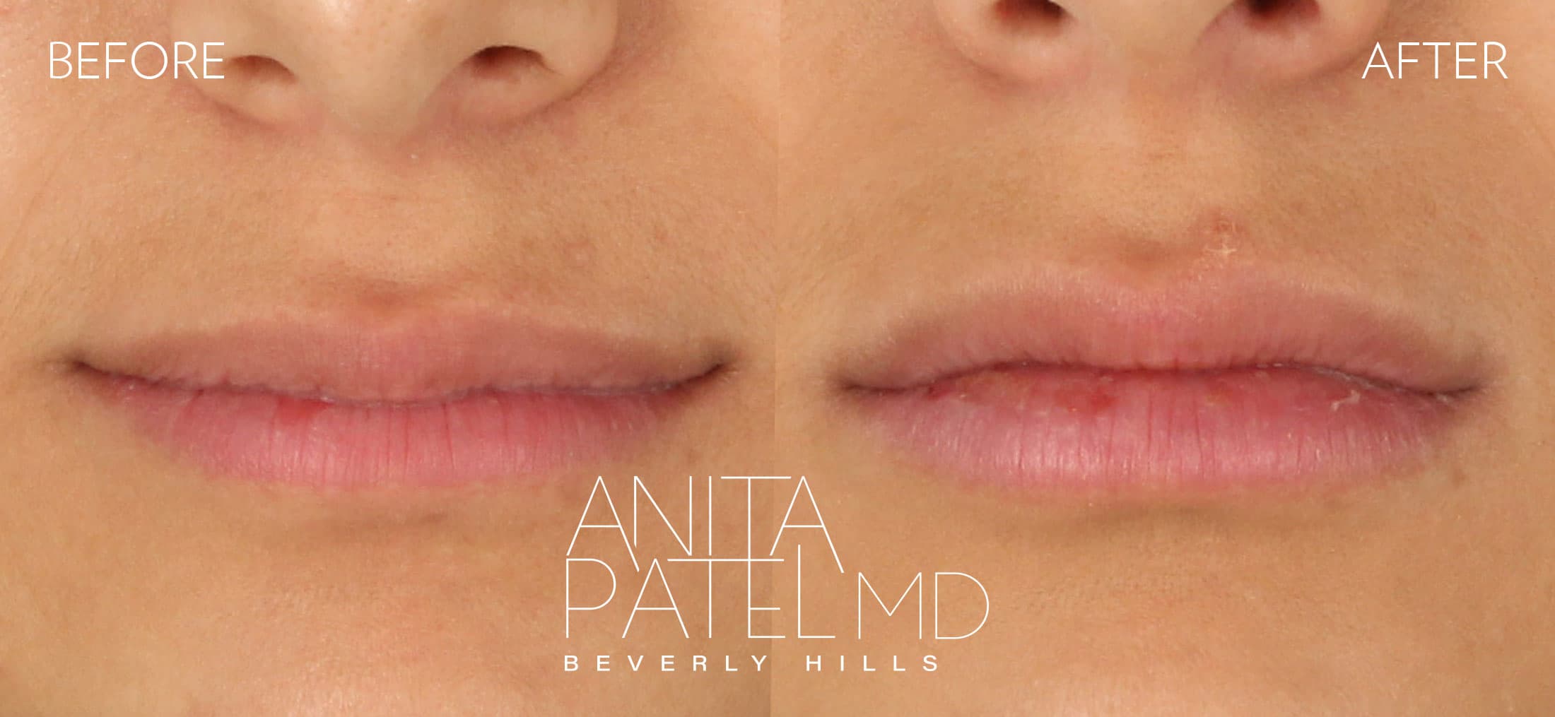 Neurotoxin before and after — Patient 1, photo 1 of 3 — Dr. Anita Patel, MD, FACS, Beverly Hills