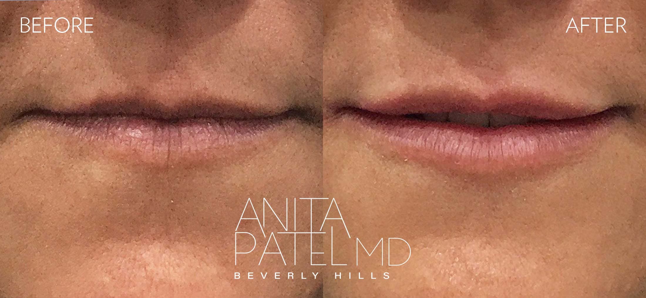 Lip Fillers before and after — Patient 13 — Dr. Anita Patel, MD, FACS, Beverly Hills