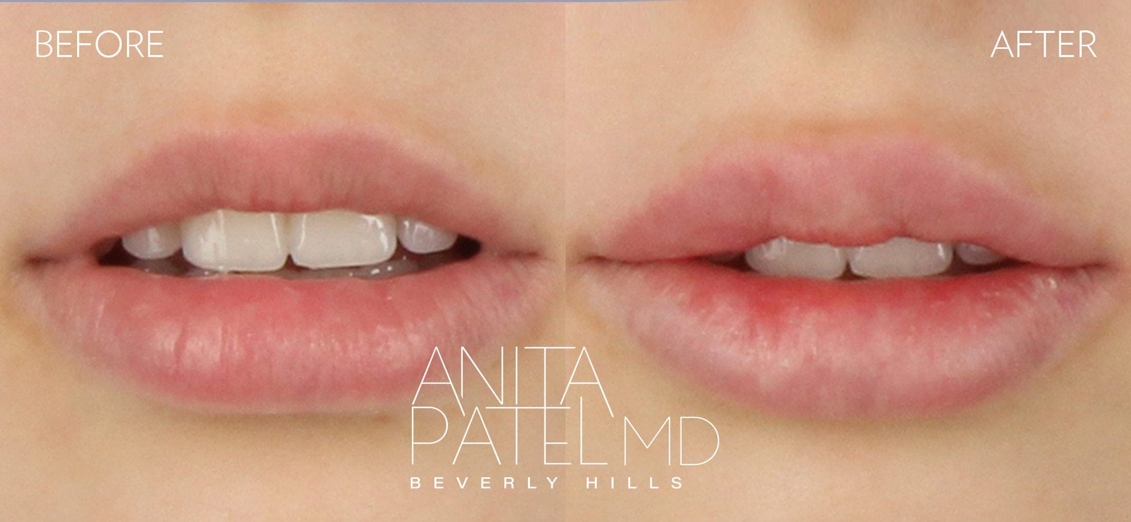 Lip Fillers before and after — Patient 11, photo 2 of 2 — Dr. Anita Patel, MD, FACS, Beverly Hills