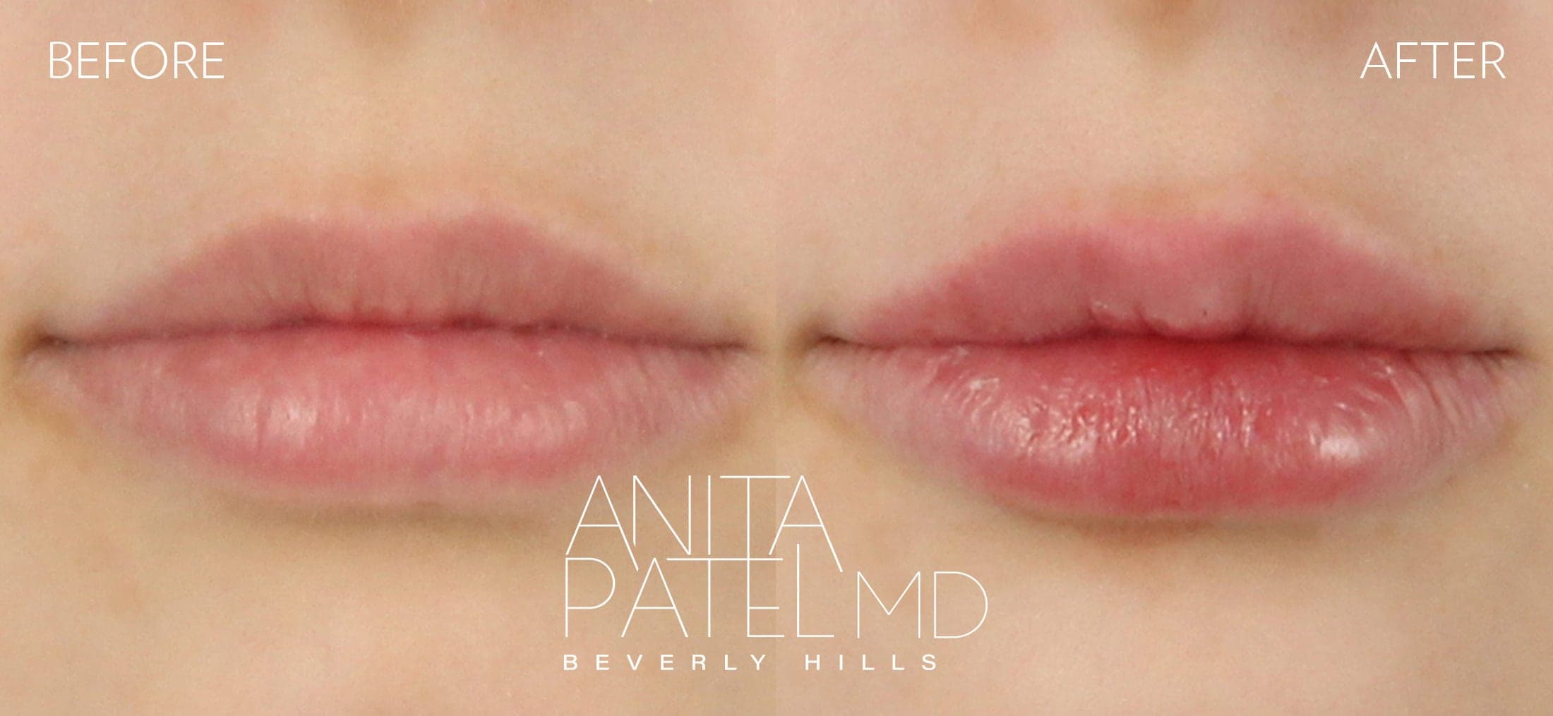 Lip Fillers before and after — Patient 11, photo 1 of 2 — Dr. Anita Patel, MD, FACS, Beverly Hills