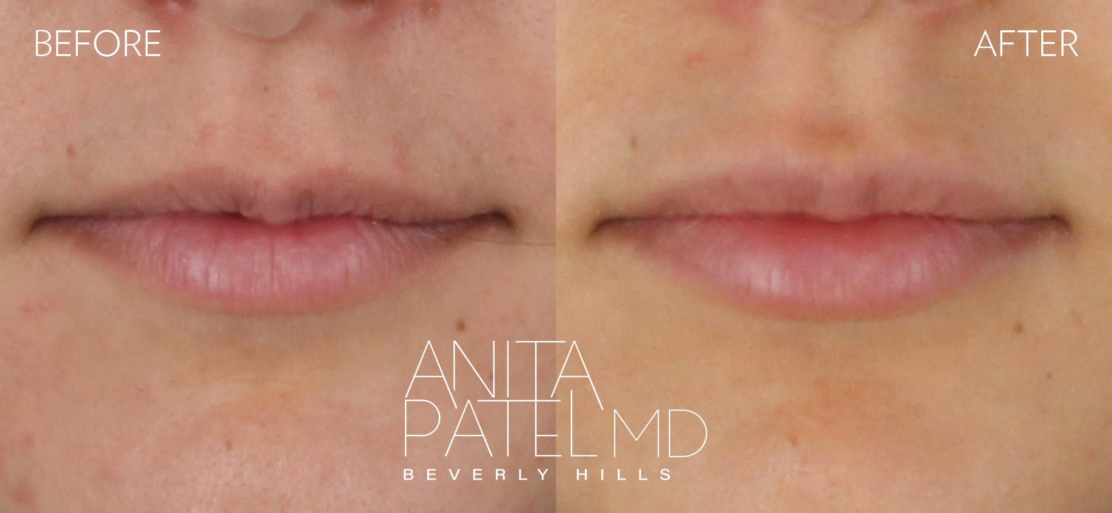 Lip Fillers before and after — Patient 14 — Dr. Anita Patel, MD, FACS, Beverly Hills