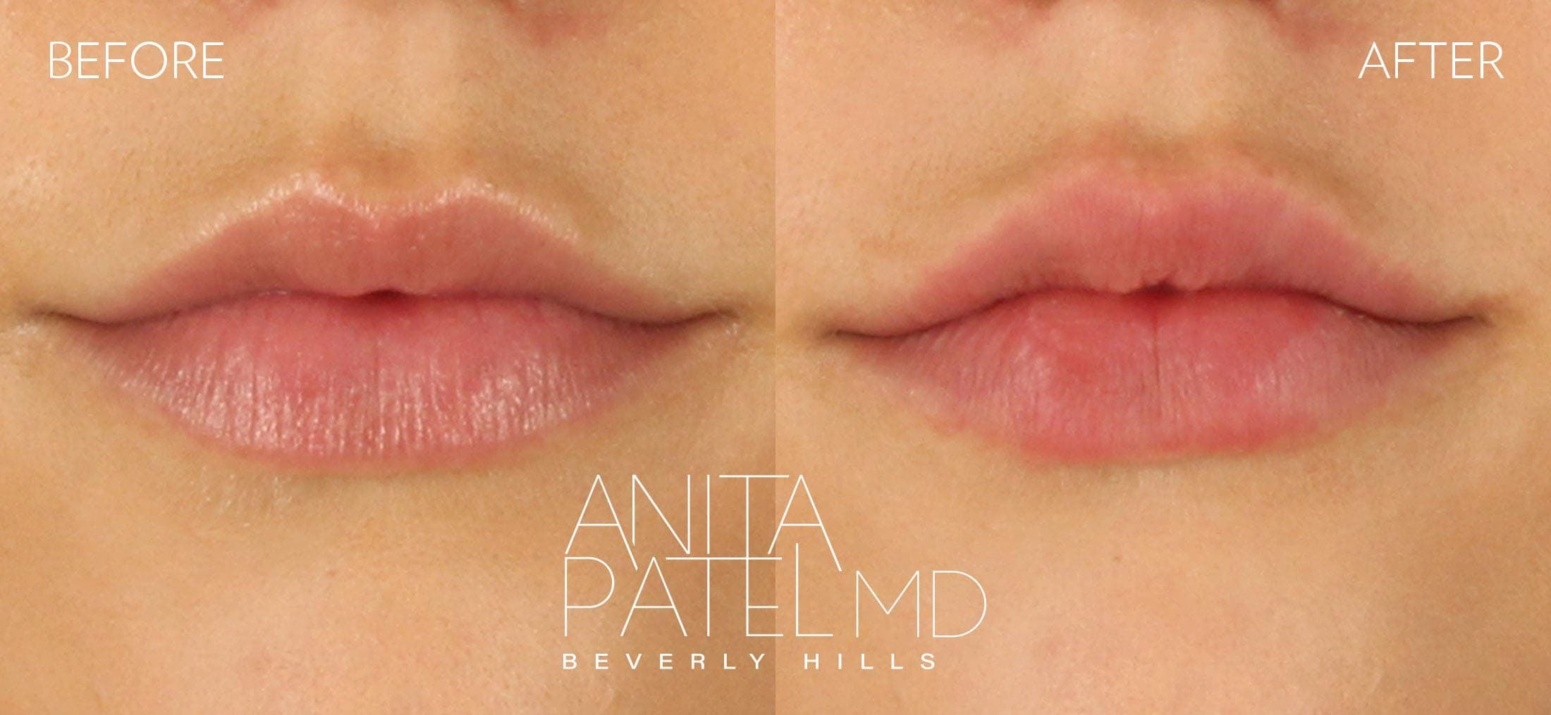 Lip Fillers before and after — Patient 15, photo 1 of 4 — Dr. Anita Patel, MD, FACS, Beverly Hills