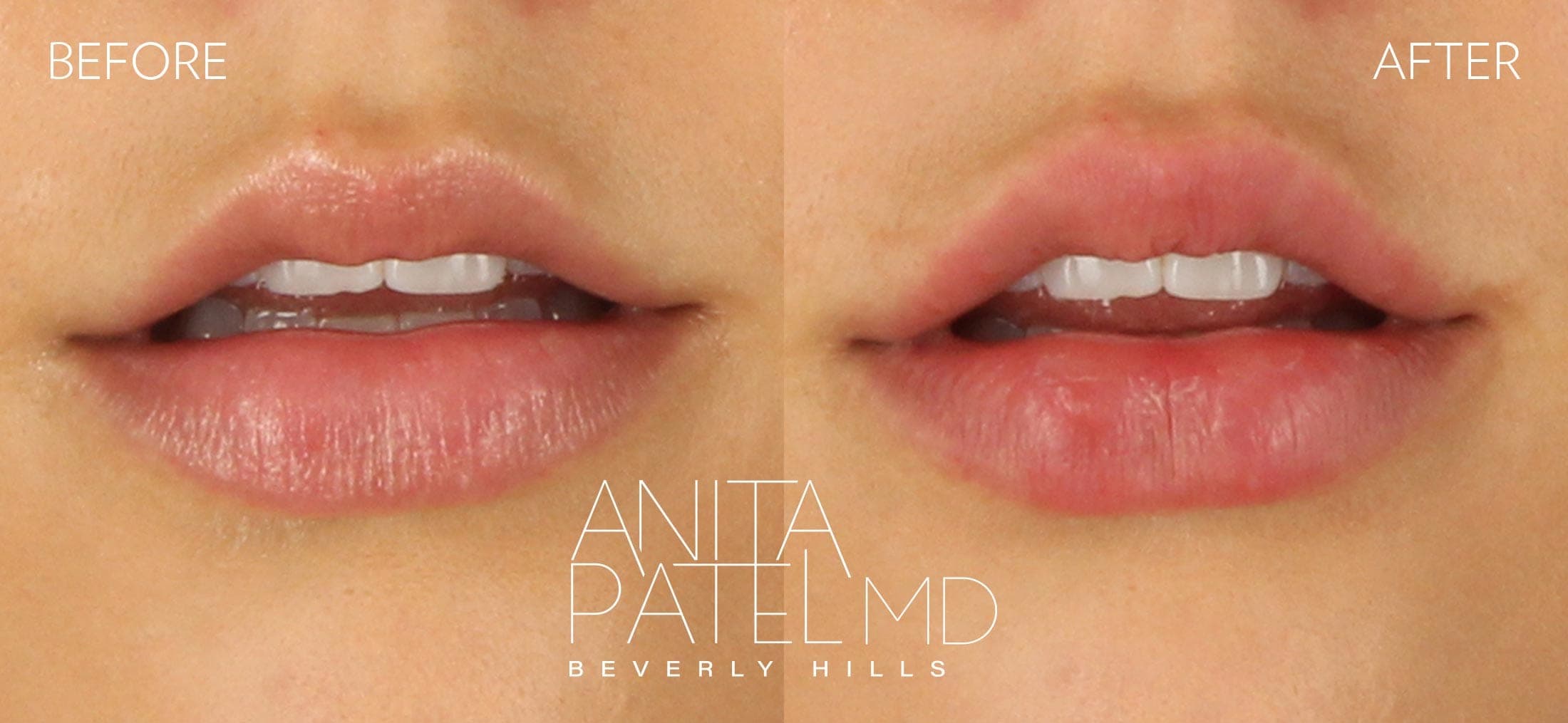 Lip Fillers before and after — Patient 15, photo 2 of 4 — Dr. Anita Patel, MD, FACS, Beverly Hills