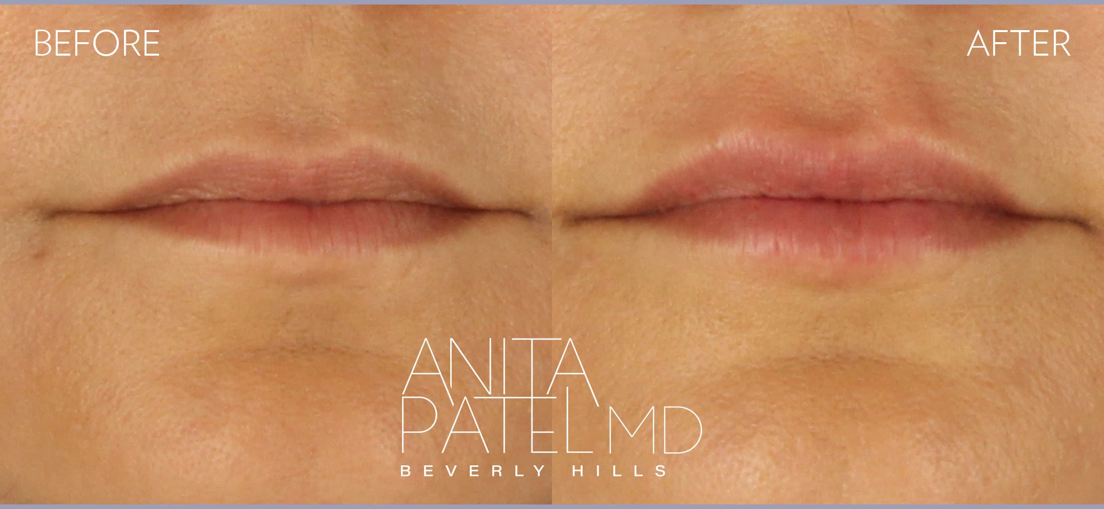 Lip Fillers before and after — Patient 16 — Dr. Anita Patel, MD, FACS, Beverly Hills