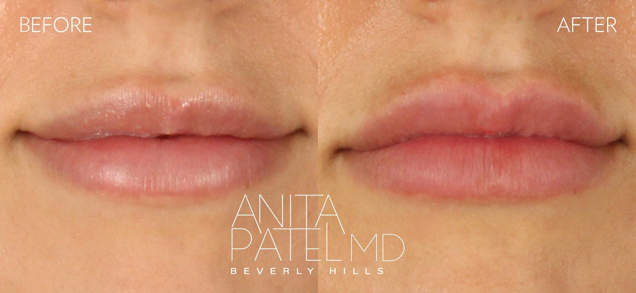 Lip Fillers before and after — Patient 15, photo 3 of 4 — Dr. Anita Patel, MD, FACS, Beverly Hills