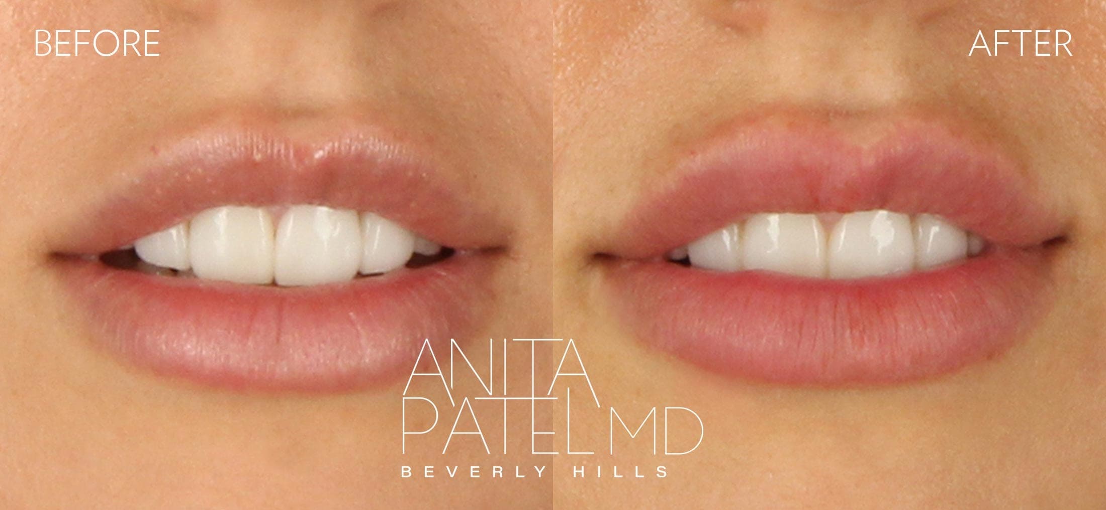 Lip Fillers before and after — Patient 15, photo 4 of 4 — Dr. Anita Patel, MD, FACS, Beverly Hills