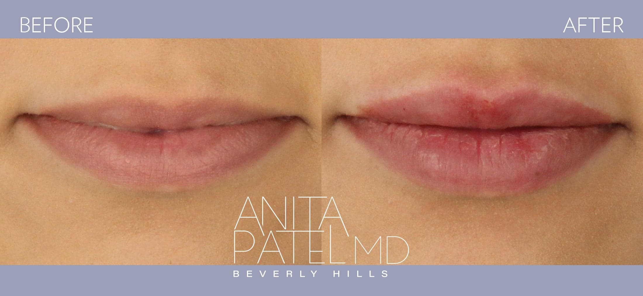 Lip Fillers before and after — Patient 18 — Dr. Anita Patel, MD, FACS, Beverly Hills