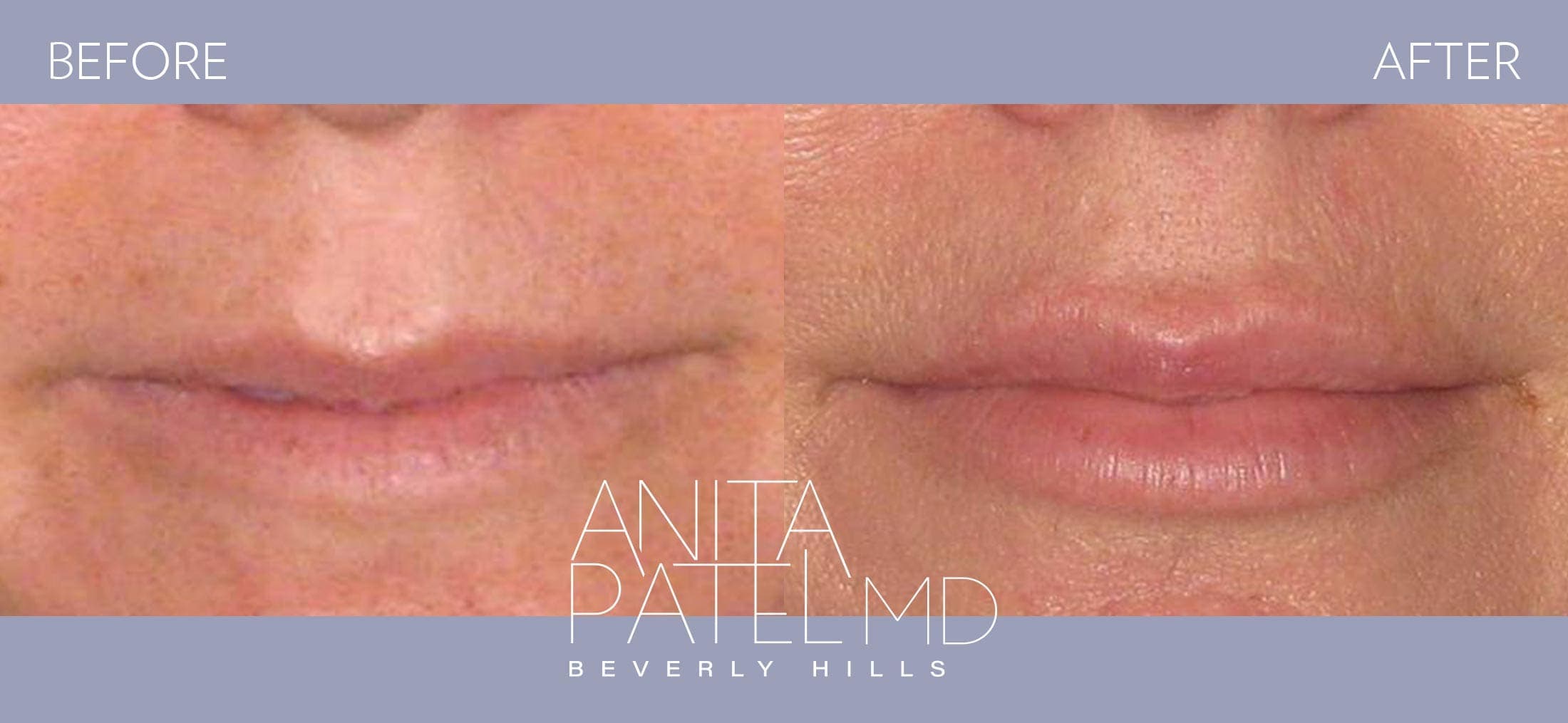 Lip Fillers before and after — Patient 19 — Dr. Anita Patel, MD, FACS, Beverly Hills