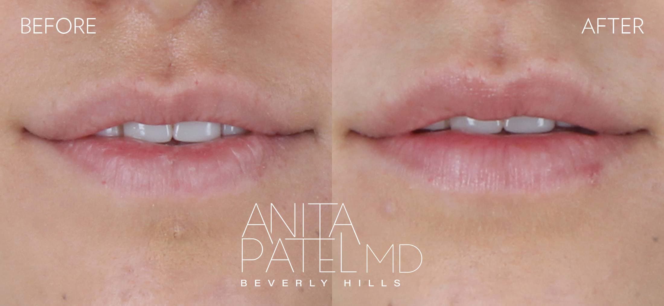 Lip Fillers before and after — Patient 20, photo 2 of 2 — Dr. Anita Patel, MD, FACS, Beverly Hills