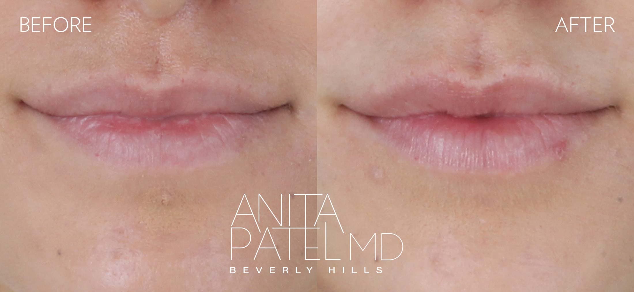 Lip Fillers before and after — Patient 20, photo 1 of 2 — Dr. Anita Patel, MD, FACS, Beverly Hills