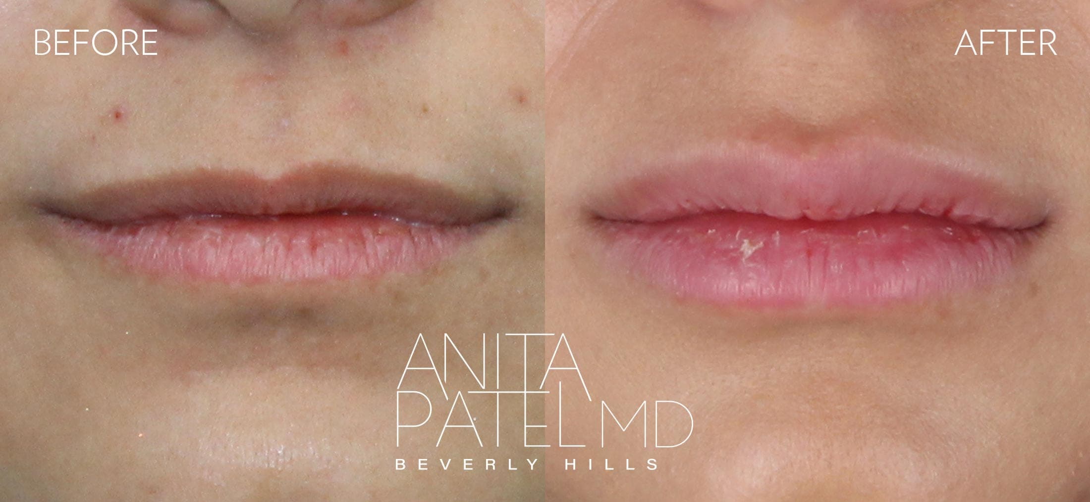 Lip Fillers before and after — Patient 22, photo 1 of 2 — Dr. Anita Patel, MD, FACS, Beverly Hills