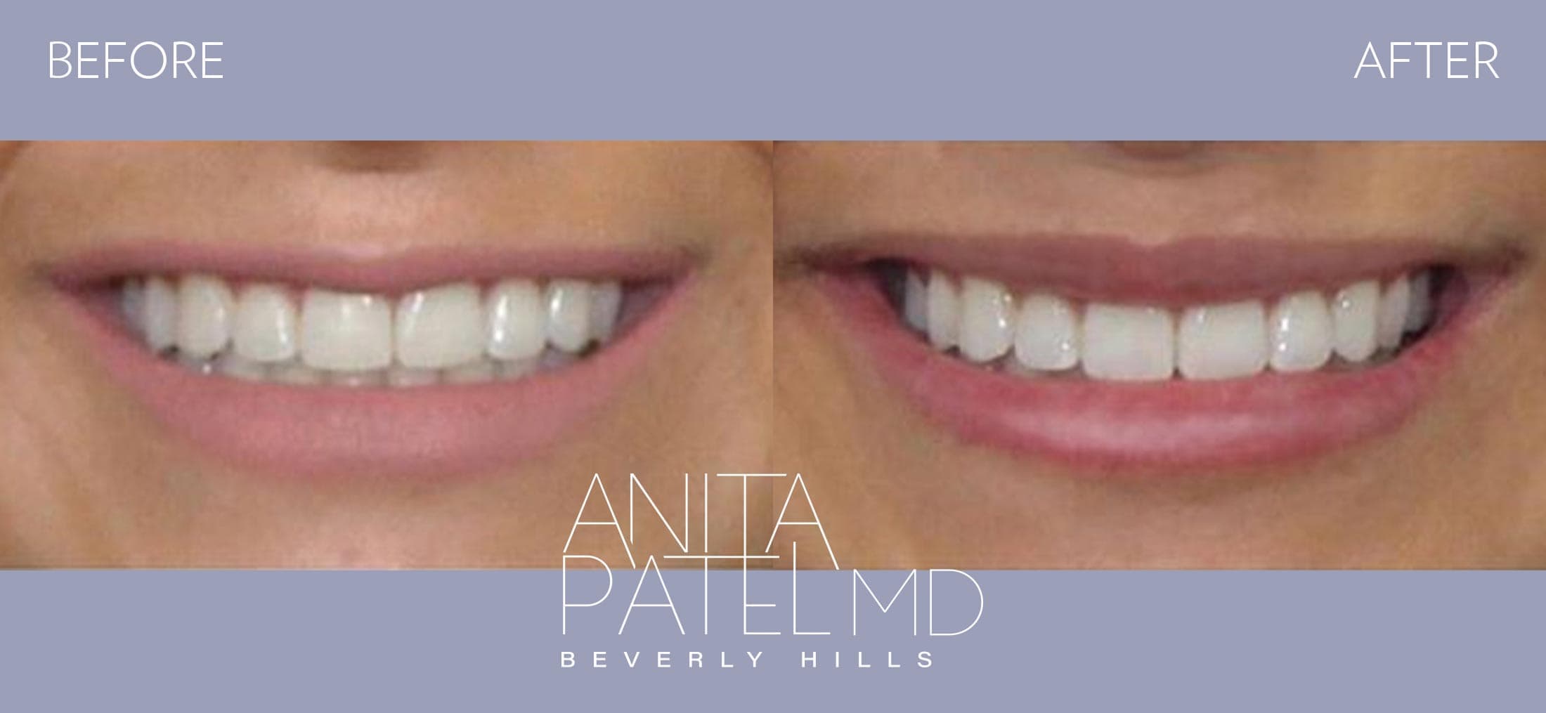 Lip Fillers before and after — Patient 22, photo 2 of 2 — Dr. Anita Patel, MD, FACS, Beverly Hills