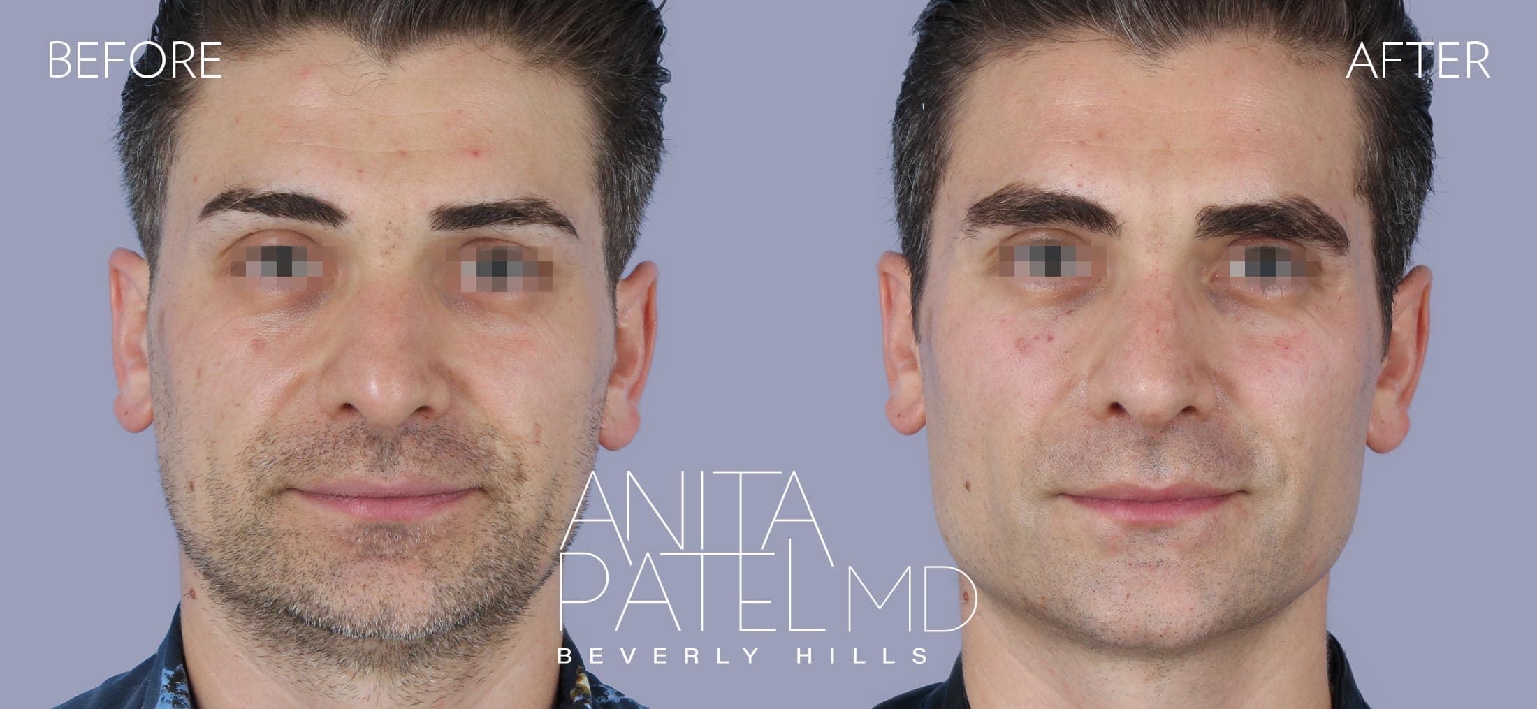 Liquid Makeover® before and after — Patient 11, photo 1 of 3 — Dr. Anita Patel, MD, FACS, Beverly Hills