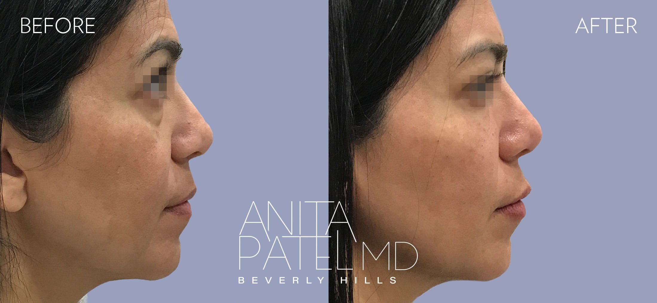 Liquid Makeover® before and after — Dr. Anita Patel, Beverly Hills