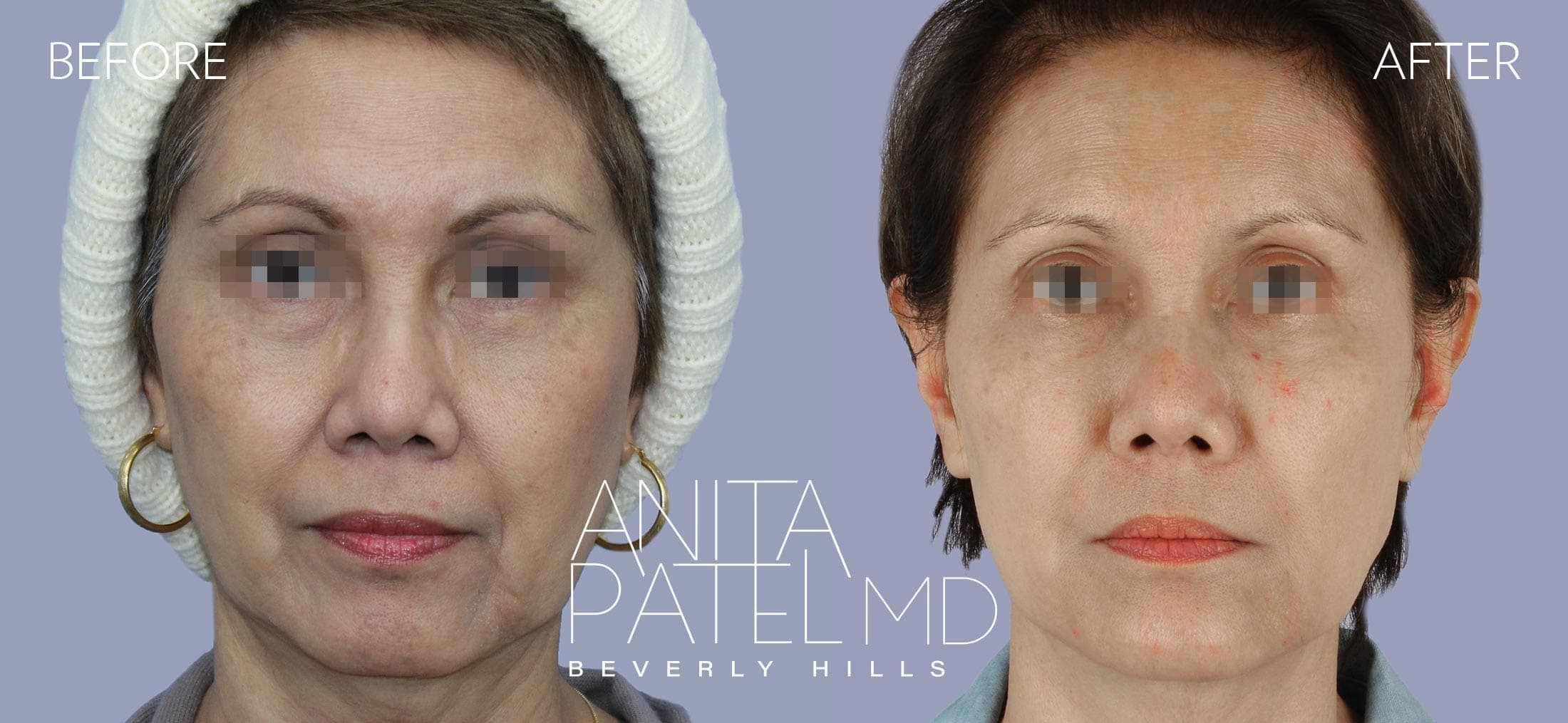 Liquid Makeover® before and after — Patient 10, photo 1 of 5 — Dr. Anita Patel, MD, FACS, Beverly Hills