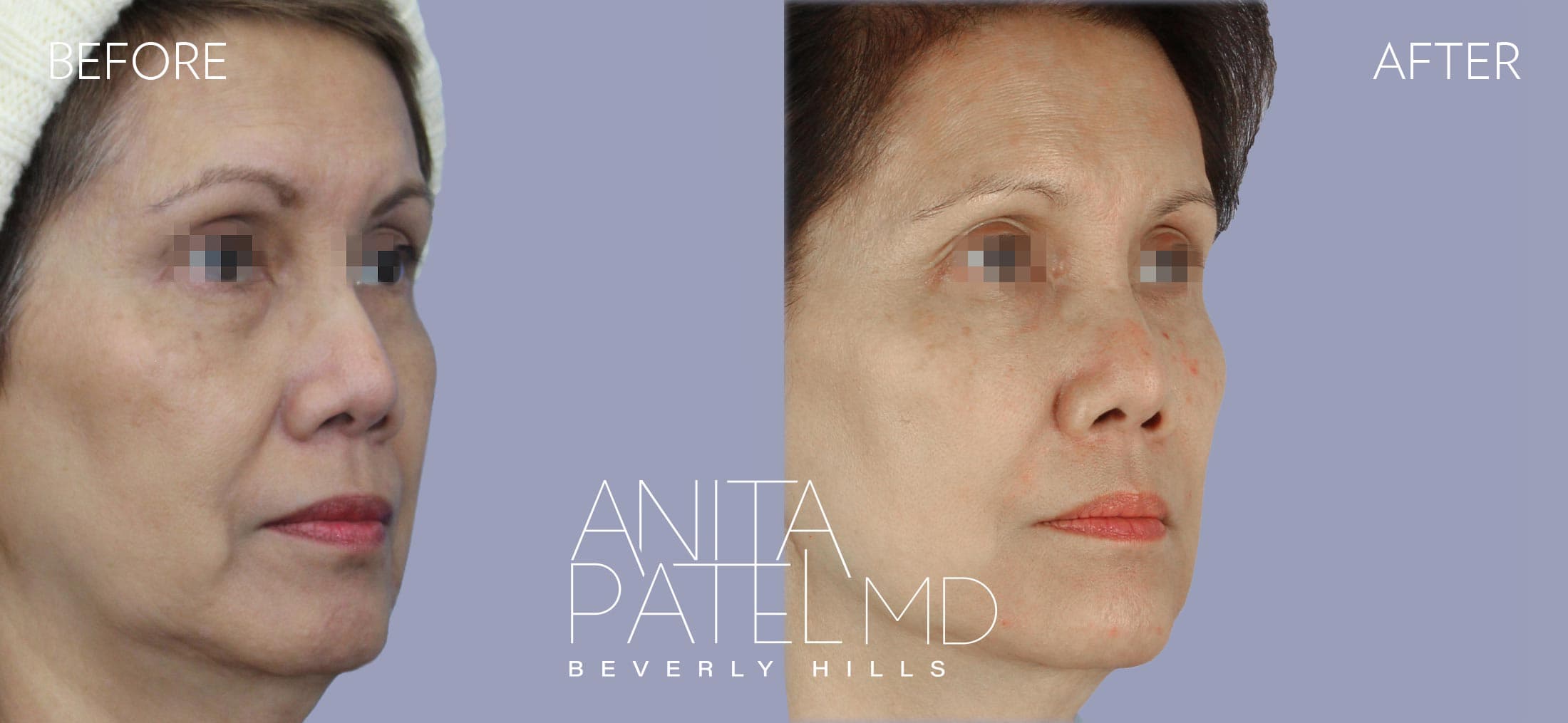 Liquid Makeover® before and after — Patient 10, photo 2 of 5 — Dr. Anita Patel, MD, FACS, Beverly Hills