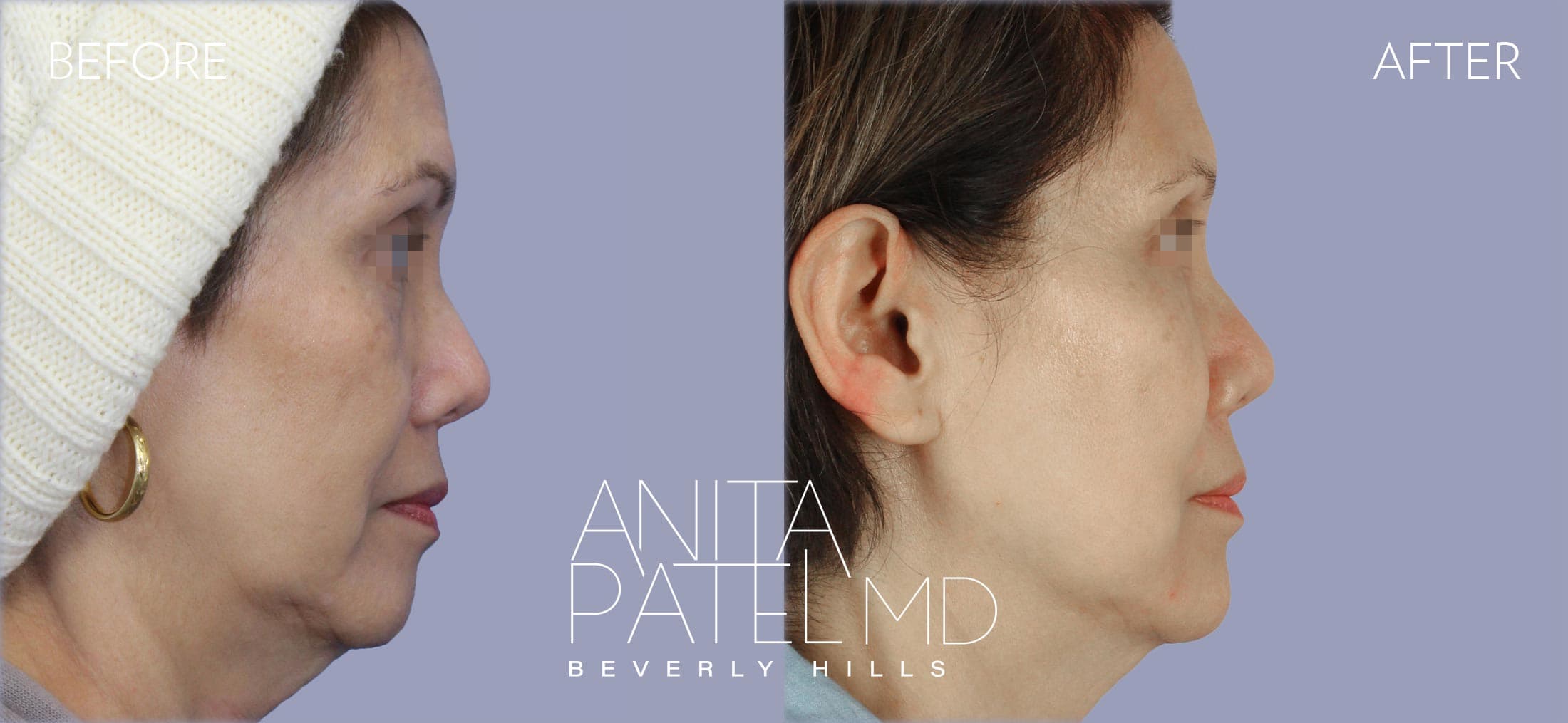 Liquid Makeover® before and after — Patient 10, photo 3 of 5 — Dr. Anita Patel, MD, FACS, Beverly Hills
