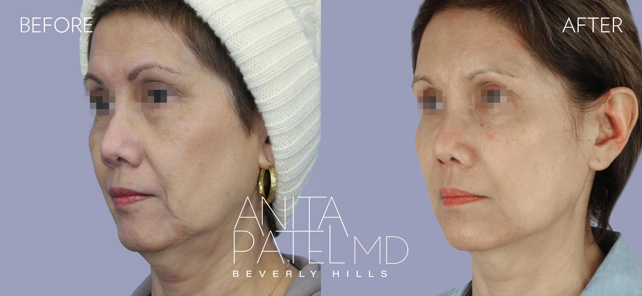 Liquid Makeover® before and after — Patient 10, photo 4 of 5 — Dr. Anita Patel, MD, FACS, Beverly Hills