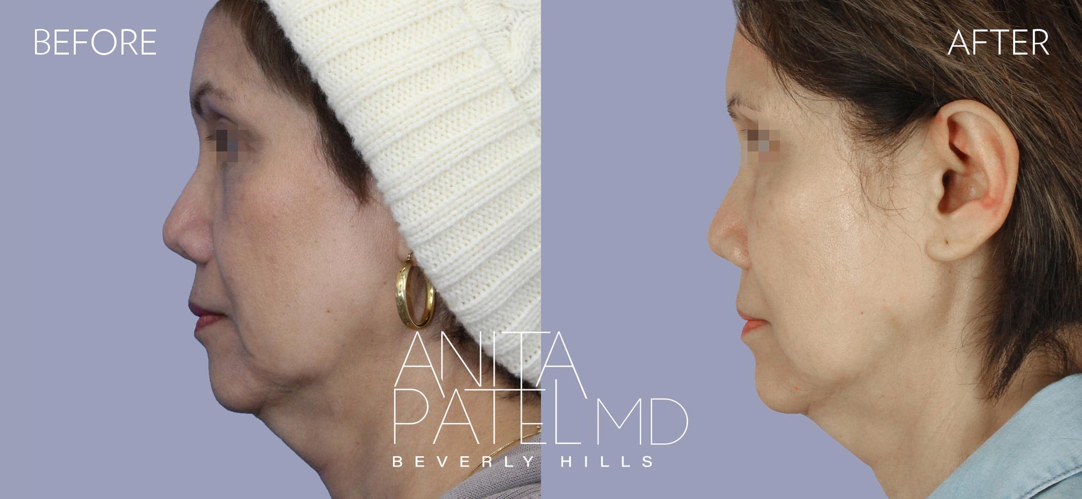 Liquid Makeover® before and after — Patient 10, photo 5 of 5 — Dr. Anita Patel, MD, FACS, Beverly Hills