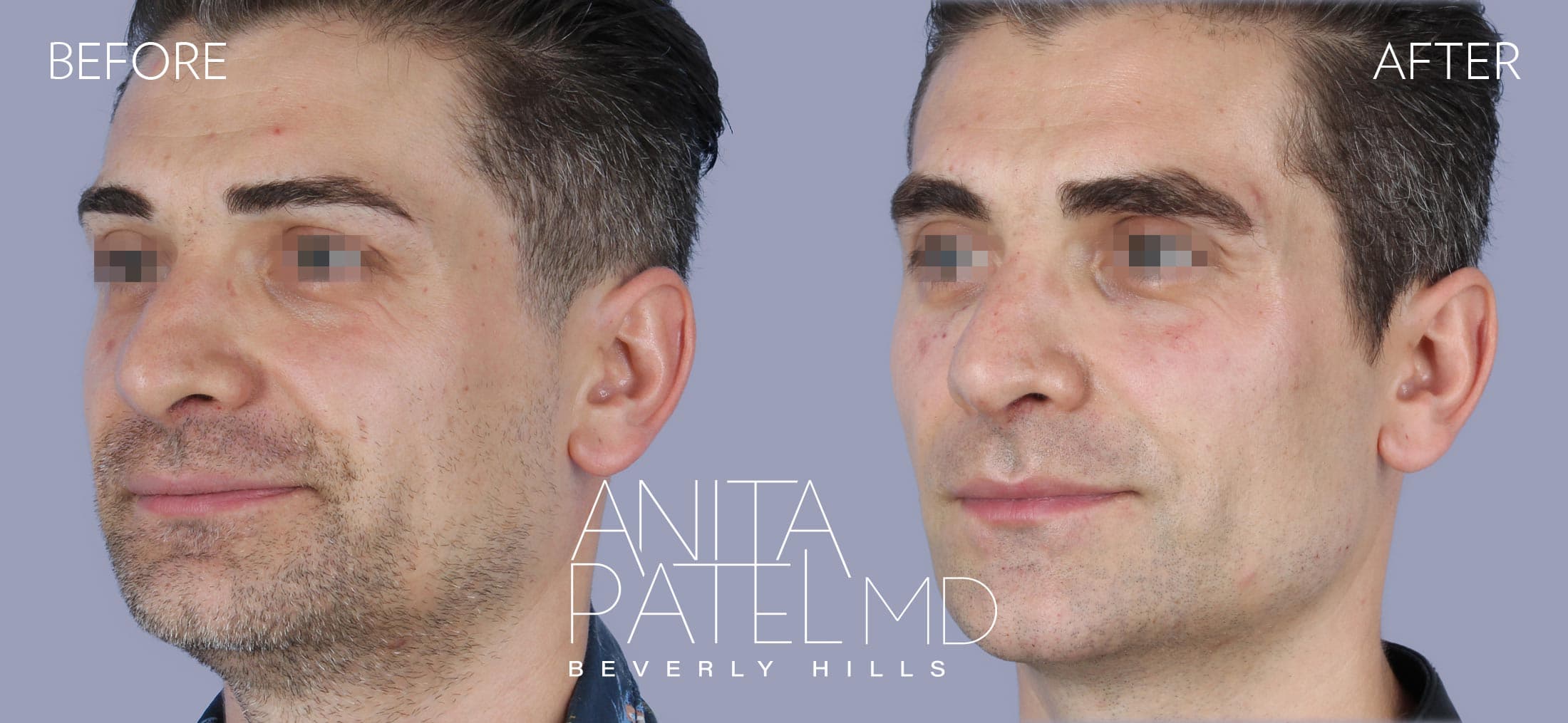 Liquid Makeover® before and after — Patient 11, photo 2 of 3 — Dr. Anita Patel, MD, FACS, Beverly Hills
