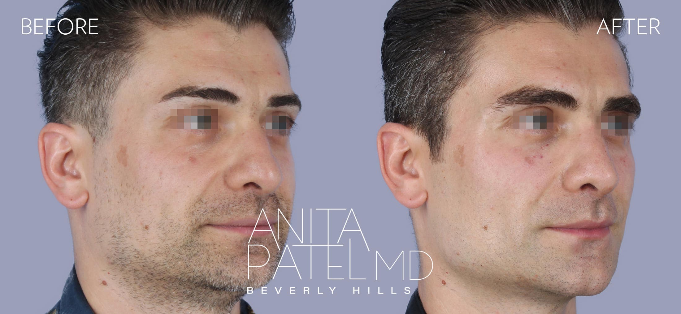 Liquid Makeover® before and after — Patient 11, photo 3 of 3 — Dr. Anita Patel, MD, FACS, Beverly Hills