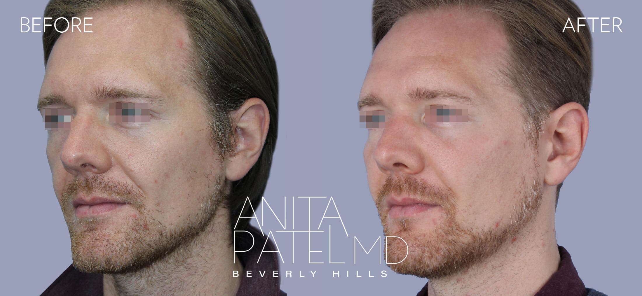 Liquid Makeover® before and after — Patient 16, photo 2 of 5 — Dr. Anita Patel, MD, FACS, Beverly Hills