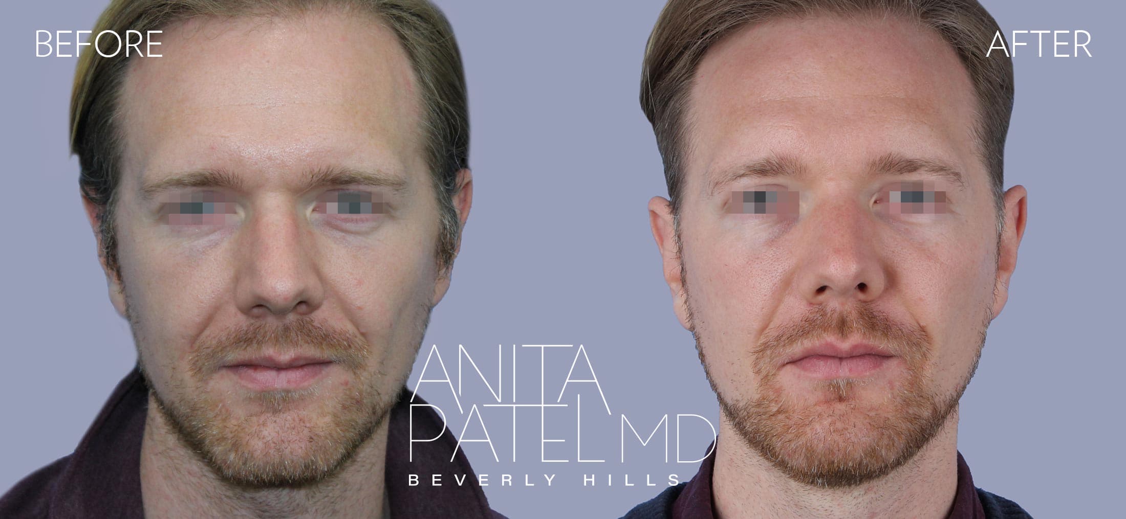 Liquid Makeover® before and after — Patient 16, photo 1 of 5 — Dr. Anita Patel, MD, FACS, Beverly Hills
