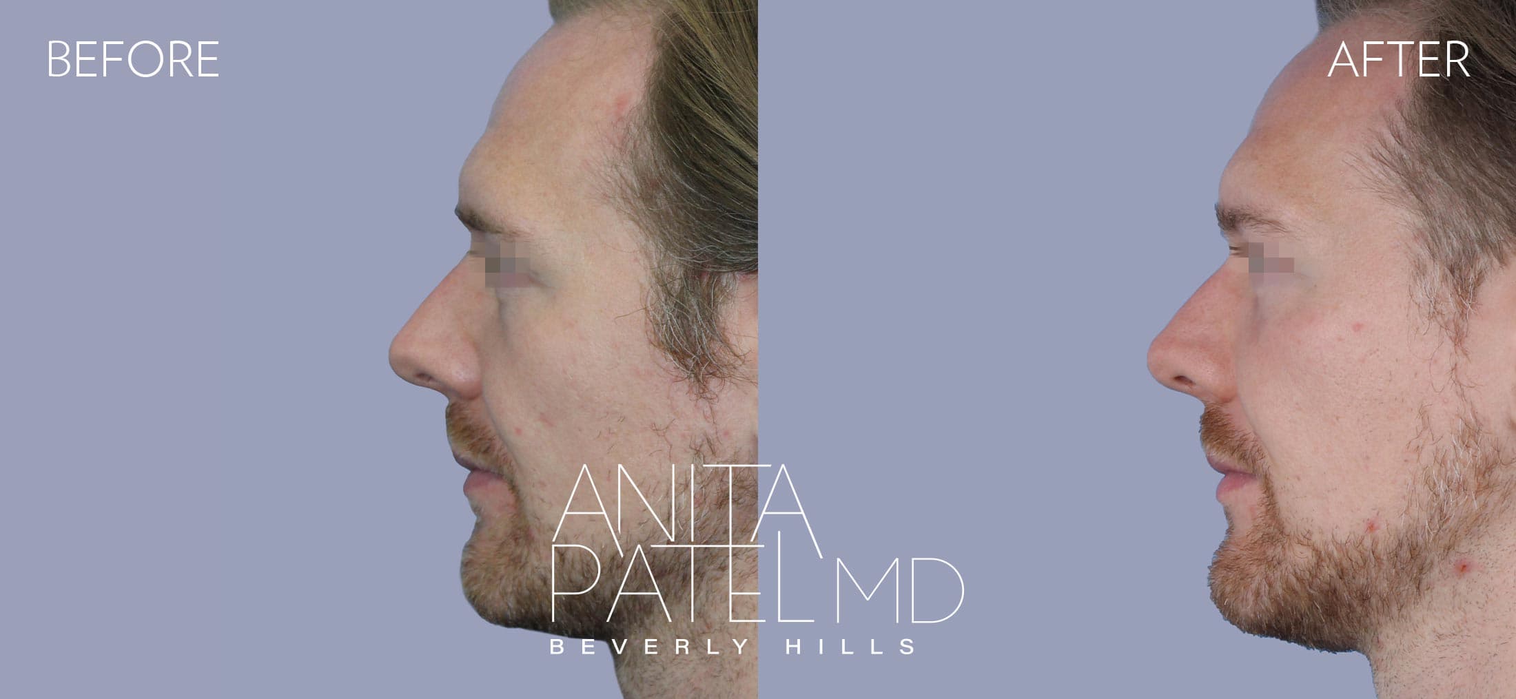 Liquid Makeover® before and after — Patient 16, photo 5 of 5 — Dr. Anita Patel, MD, FACS, Beverly Hills