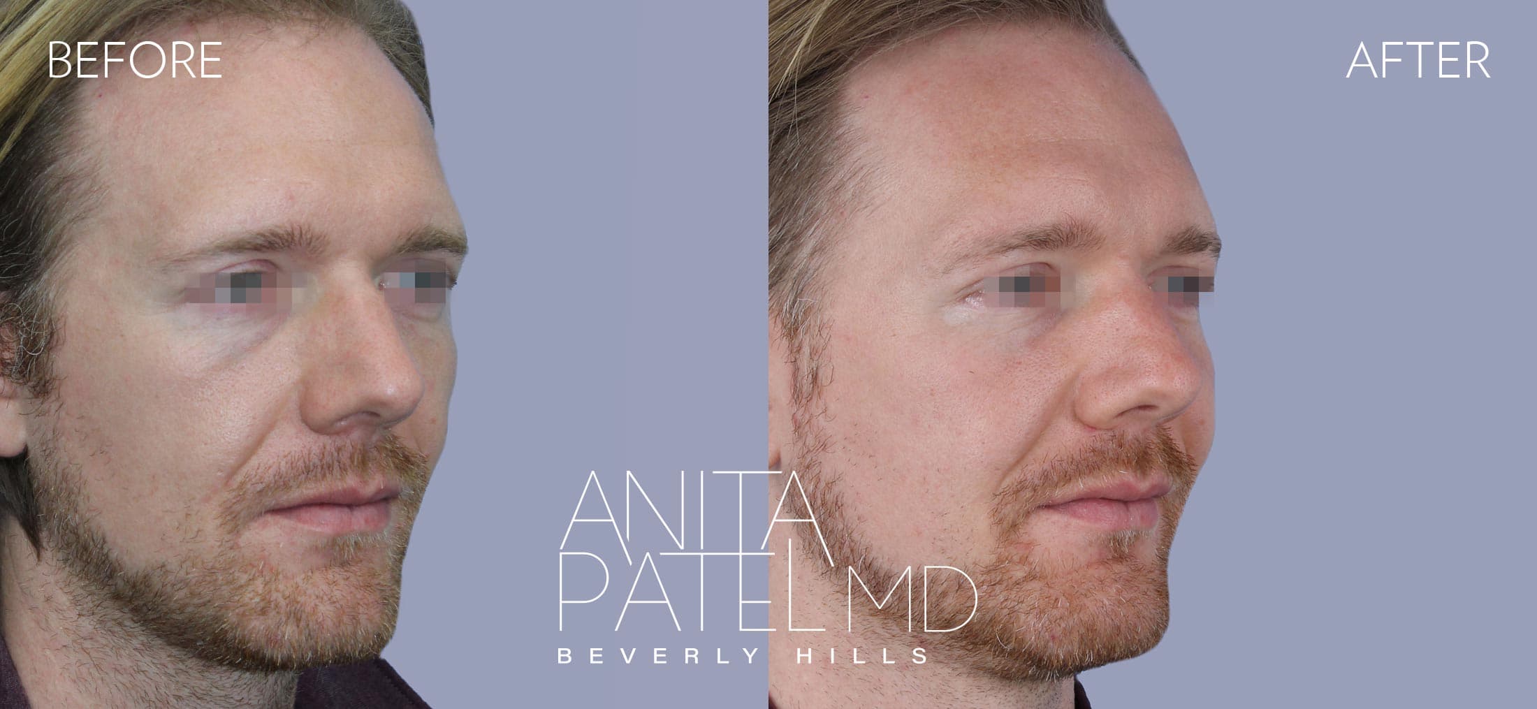 Liquid Makeover® before and after — Patient 16, photo 4 of 5 — Dr. Anita Patel, MD, FACS, Beverly Hills