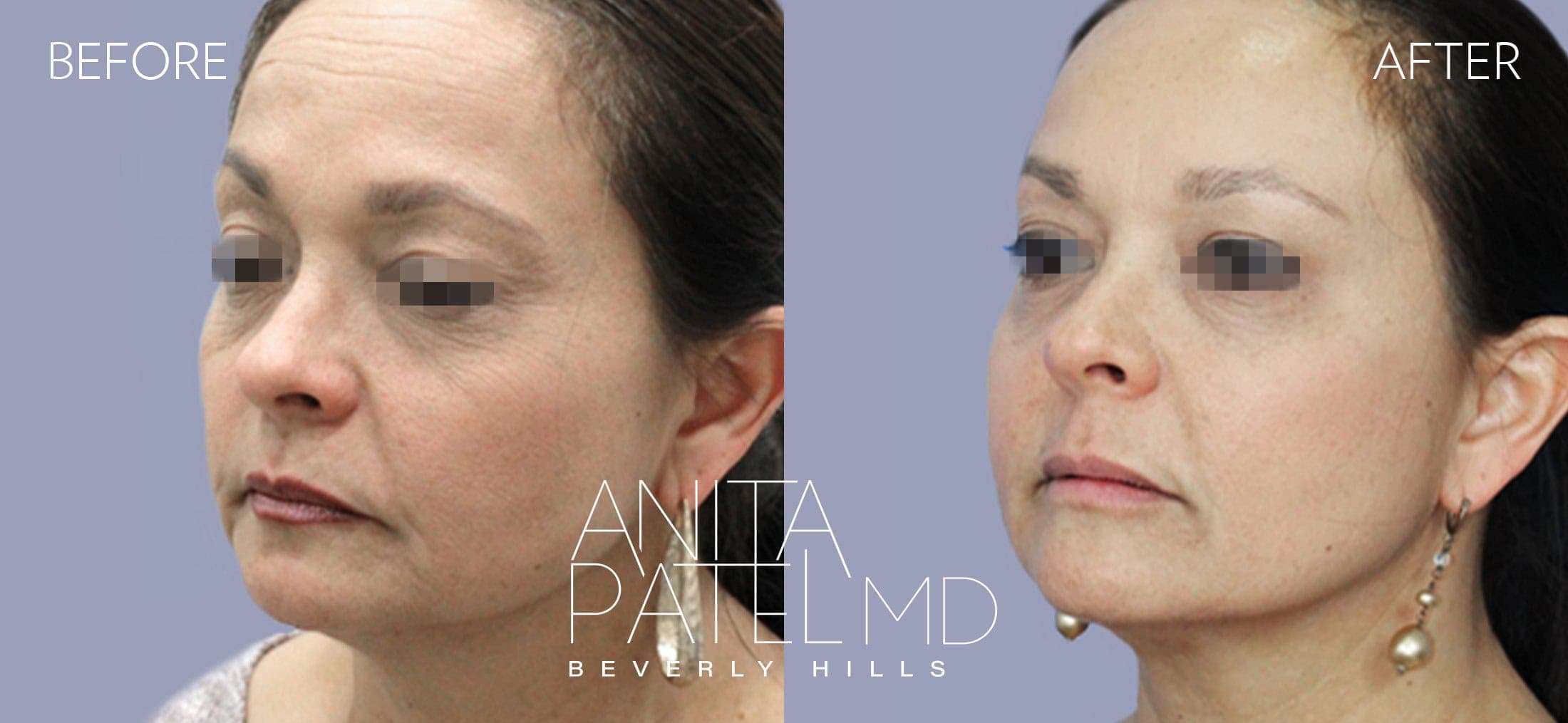 Liquid Makeover® before and after — Patient 13, photo 2 of 4 — Dr. Anita Patel, MD, FACS, Beverly Hills