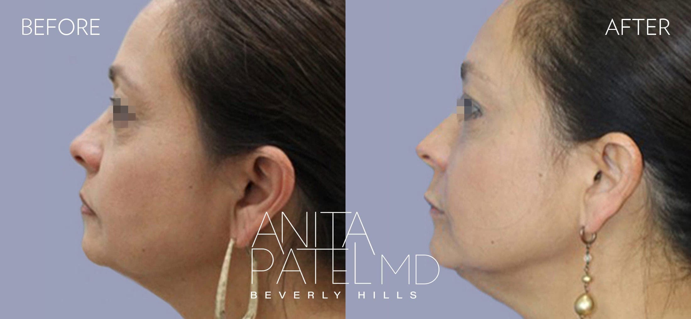 Liquid Makeover® before and after — Patient 13, photo 3 of 4 — Dr. Anita Patel, MD, FACS, Beverly Hills