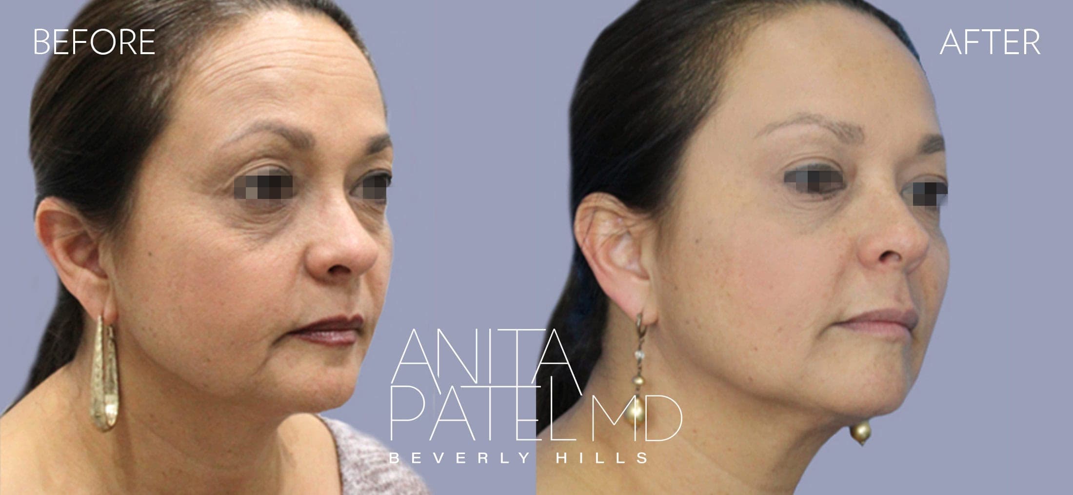 Liquid Makeover® before and after — Patient 13, photo 4 of 4 — Dr. Anita Patel, MD, FACS, Beverly Hills