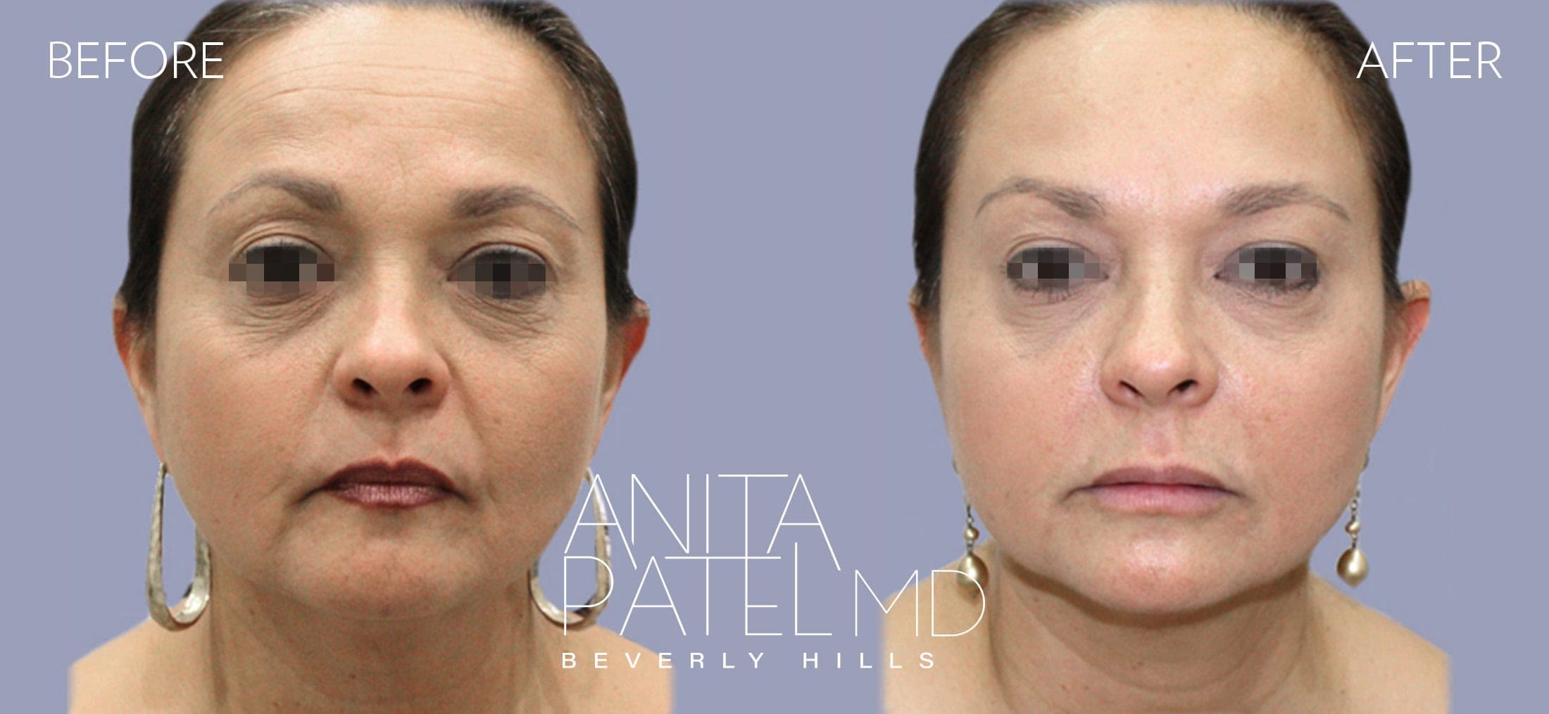Liquid Makeover® before and after — Patient 13, photo 1 of 4 — Dr. Anita Patel, MD, FACS, Beverly Hills