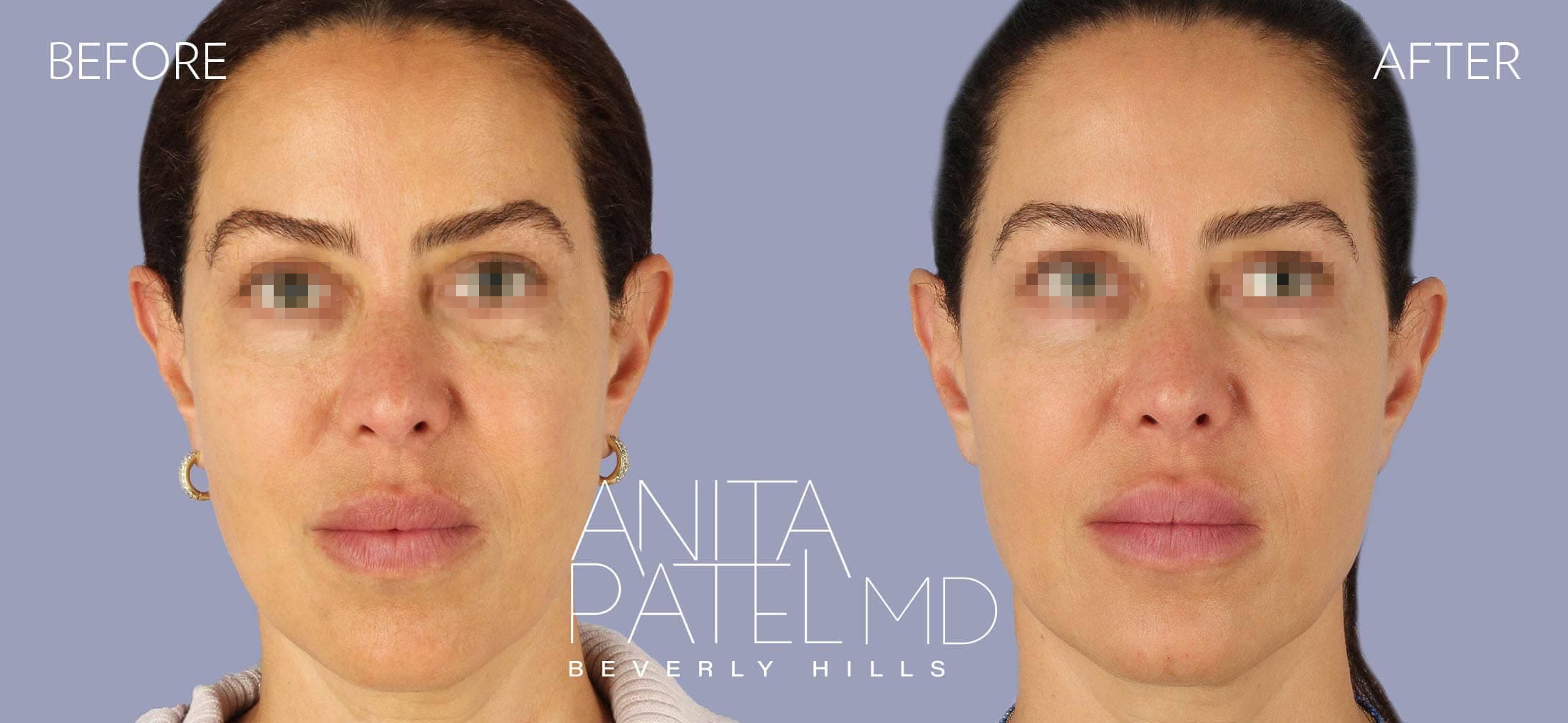 Liquid Makeover® before and after — Patient 14, photo 1 of 5 — Dr. Anita Patel, MD, FACS, Beverly Hills
