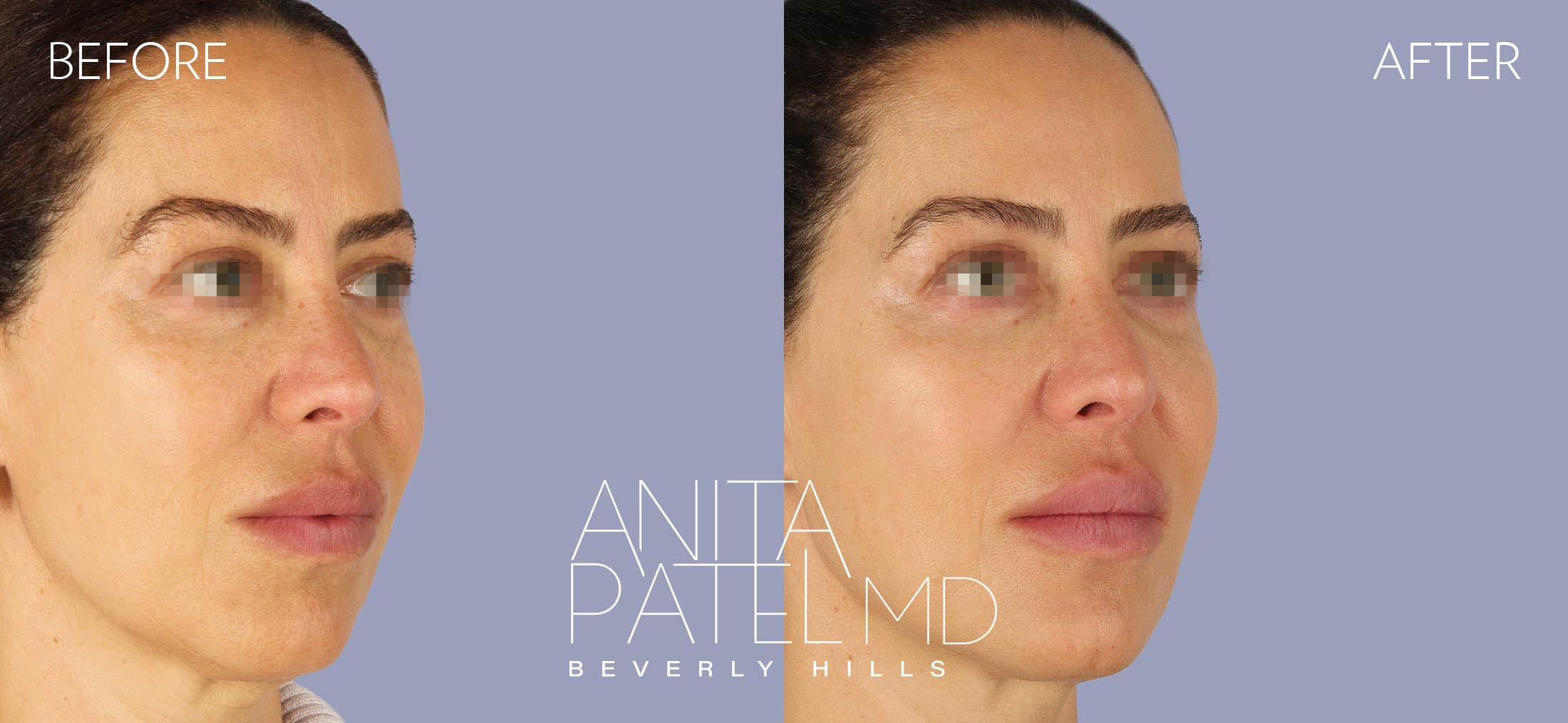 Liquid Makeover® before and after — Patient 14, photo 2 of 5 — Dr. Anita Patel, MD, FACS, Beverly Hills