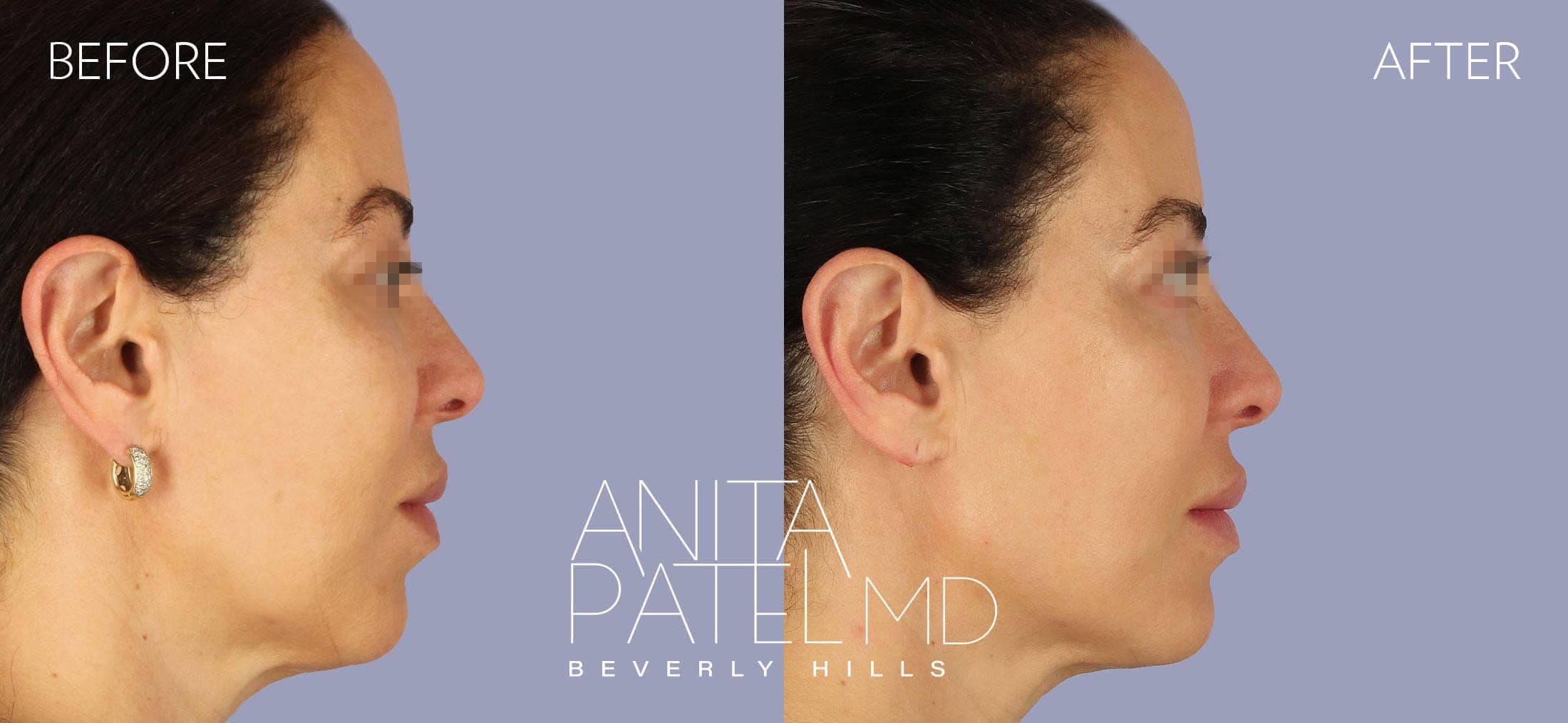 Liquid Makeover® before and after — Patient 14, photo 3 of 5 — Dr. Anita Patel, MD, FACS, Beverly Hills