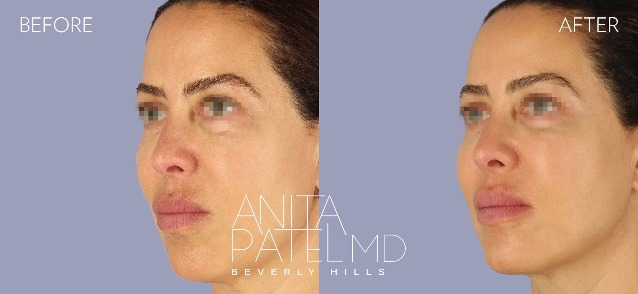 Liquid Makeover® before and after — Patient 14, photo 4 of 5 — Dr. Anita Patel, MD, FACS, Beverly Hills