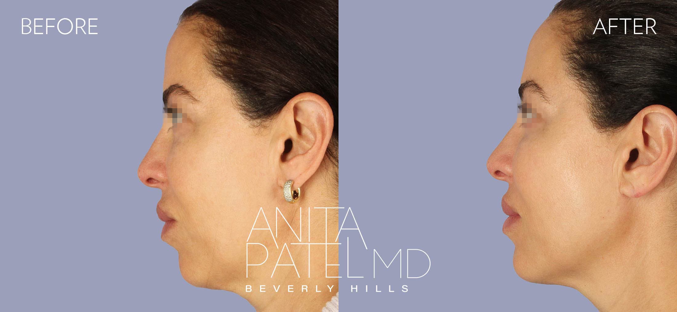 Liquid Makeover® before and after — Patient 14, photo 5 of 5 — Dr. Anita Patel, MD, FACS, Beverly Hills