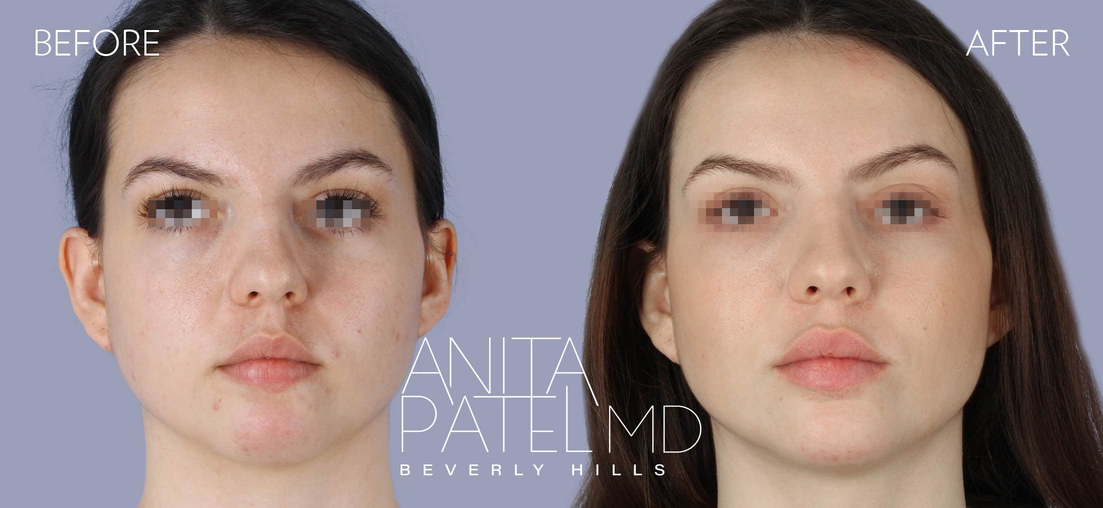 Liquid Makeover® before and after — Patient 15, photo 1 of 5 — Dr. Anita Patel, MD, FACS, Beverly Hills
