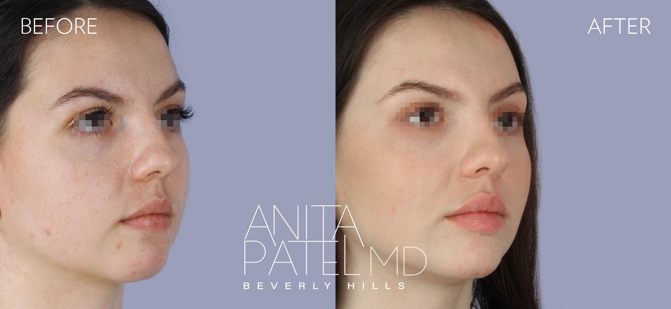 Liquid Makeover® before and after — Patient 15, photo 2 of 5 — Dr. Anita Patel, MD, FACS, Beverly Hills