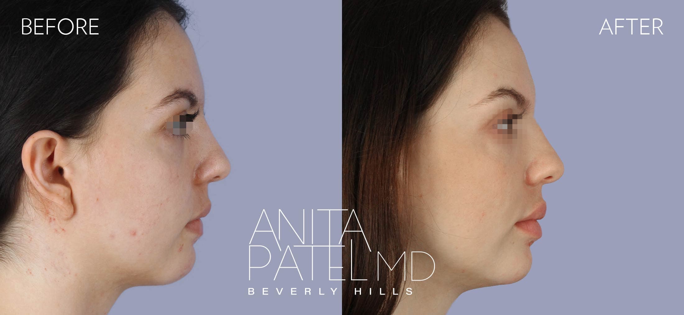 Liquid Makeover® before and after — Patient 15, photo 3 of 5 — Dr. Anita Patel, MD, FACS, Beverly Hills