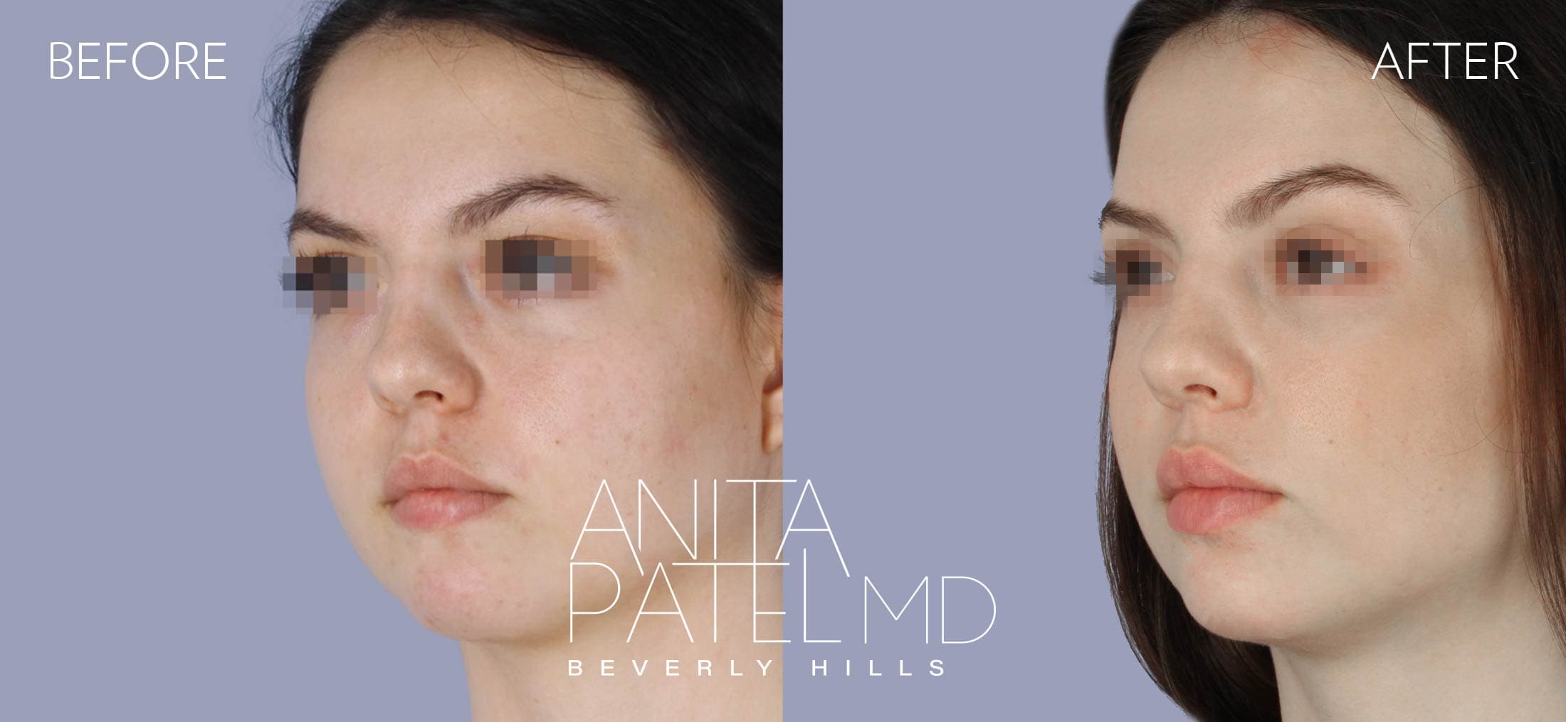 Liquid Makeover® before and after — Patient 15, photo 4 of 5 — Dr. Anita Patel, MD, FACS, Beverly Hills