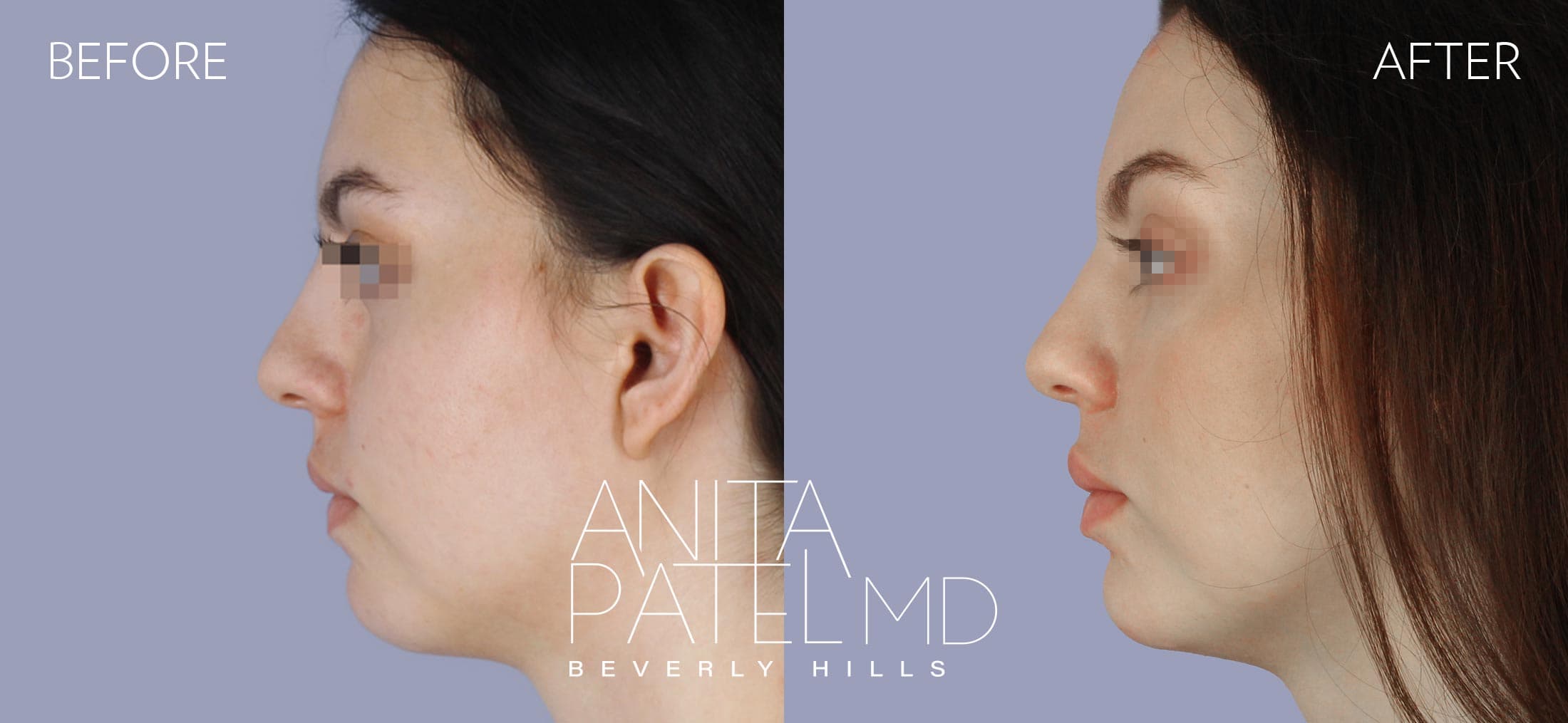 Liquid Makeover® before and after — Patient 15, photo 5 of 5 — Dr. Anita Patel, MD, FACS, Beverly Hills