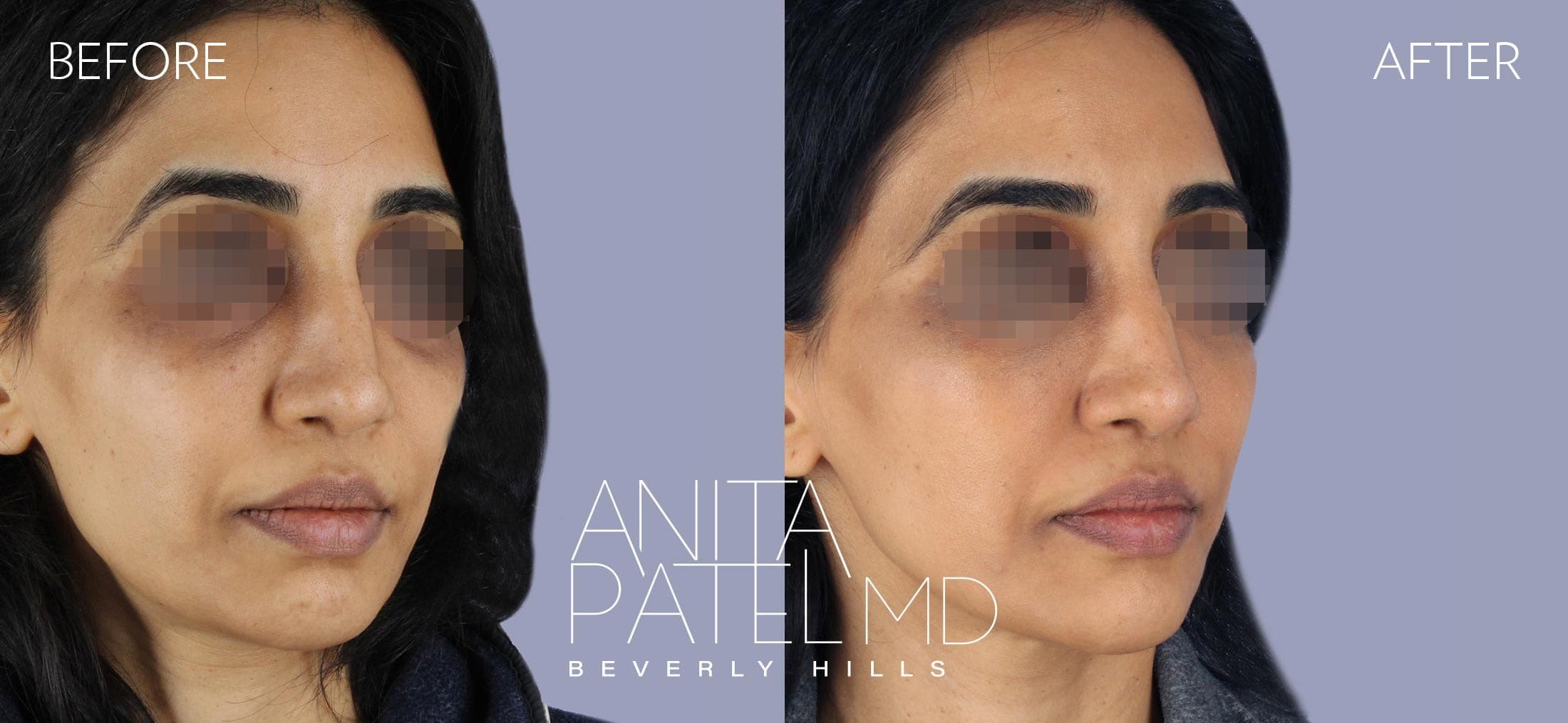 Liquid Makeover® before and after — Patient 9, photo 1 of 4 — Dr. Anita Patel, MD, FACS, Beverly Hills