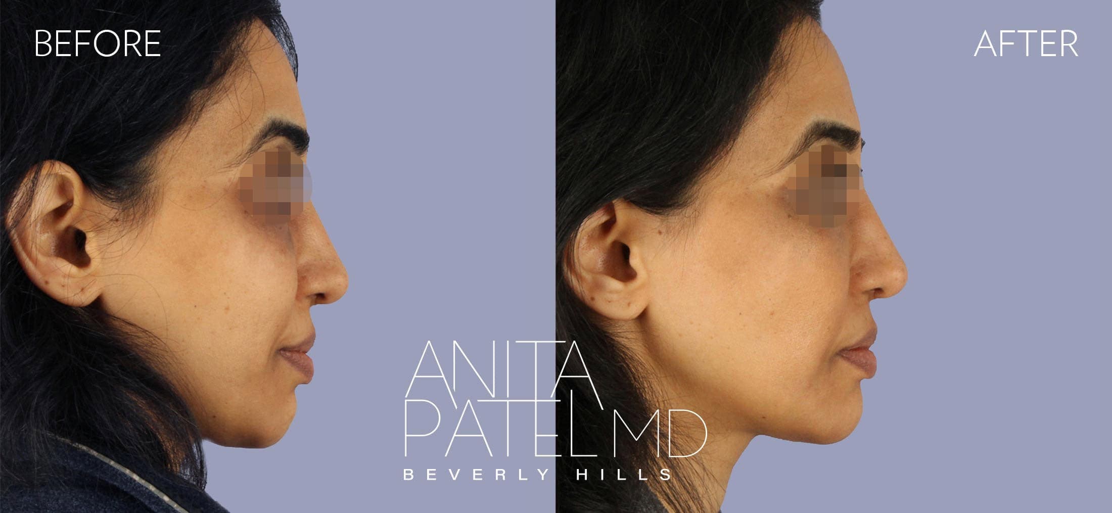 Liquid Makeover® before and after — Patient 9, photo 2 of 4 — Dr. Anita Patel, MD, FACS, Beverly Hills