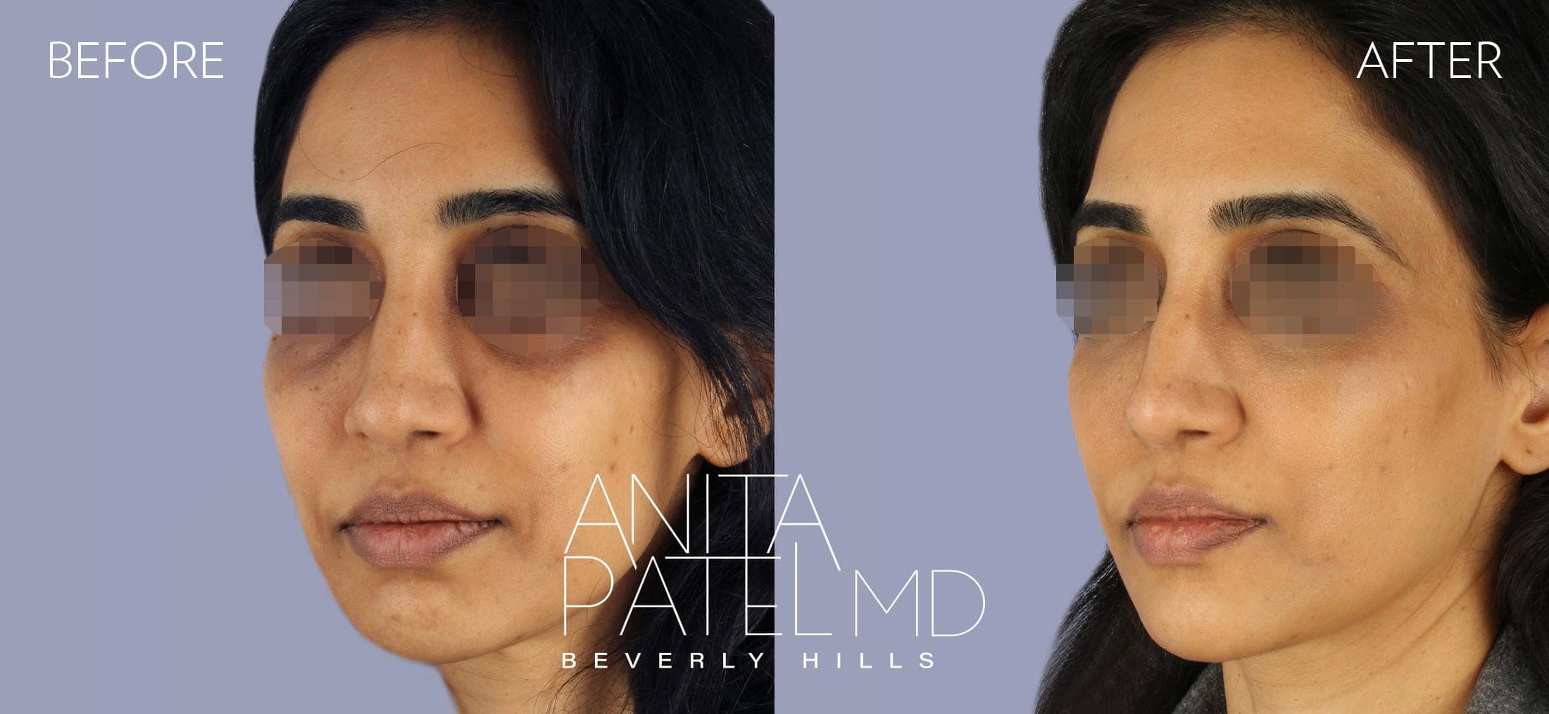 Liquid Makeover® before and after — Patient 9, photo 3 of 4 — Dr. Anita Patel, MD, FACS, Beverly Hills