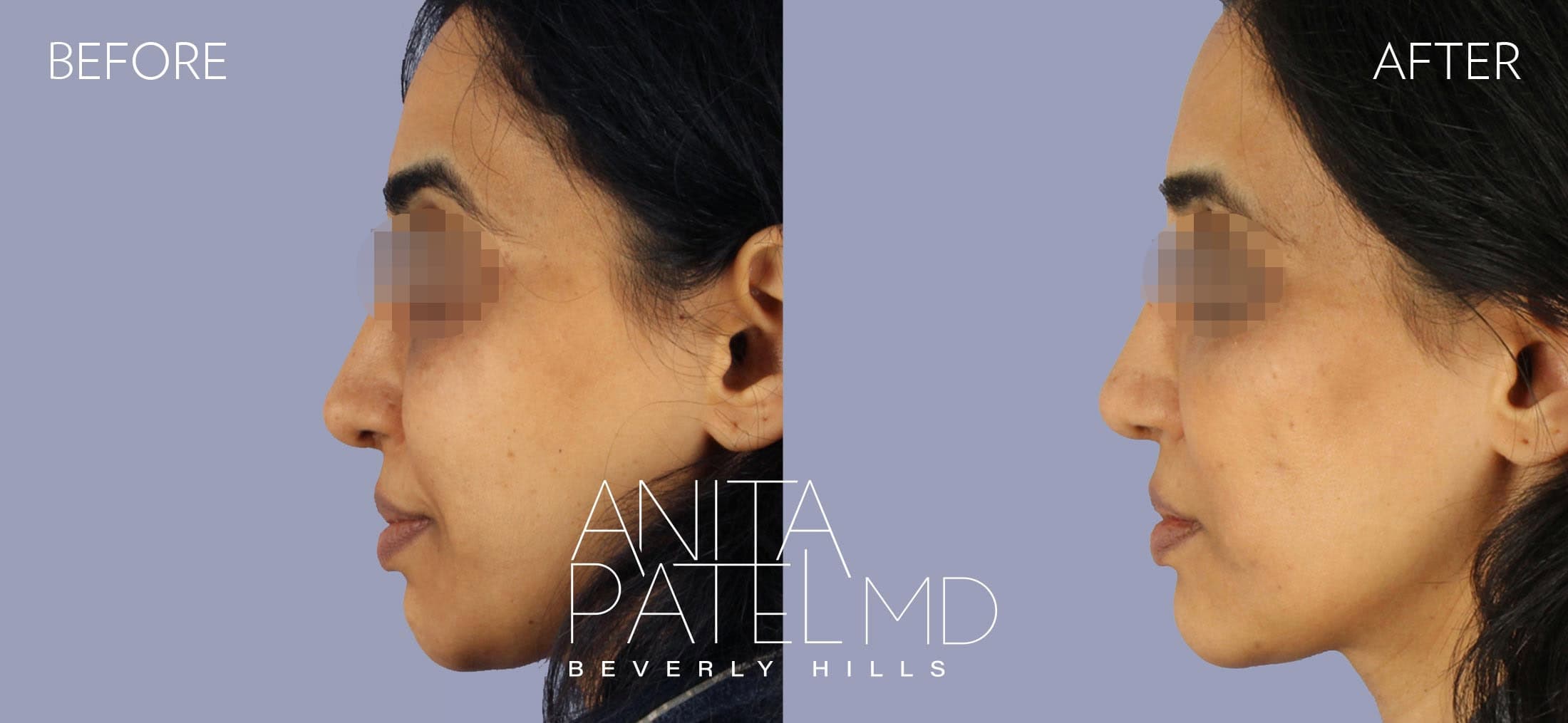 Liquid Makeover® before and after — Patient 9, photo 4 of 4 — Dr. Anita Patel, MD, FACS, Beverly Hills