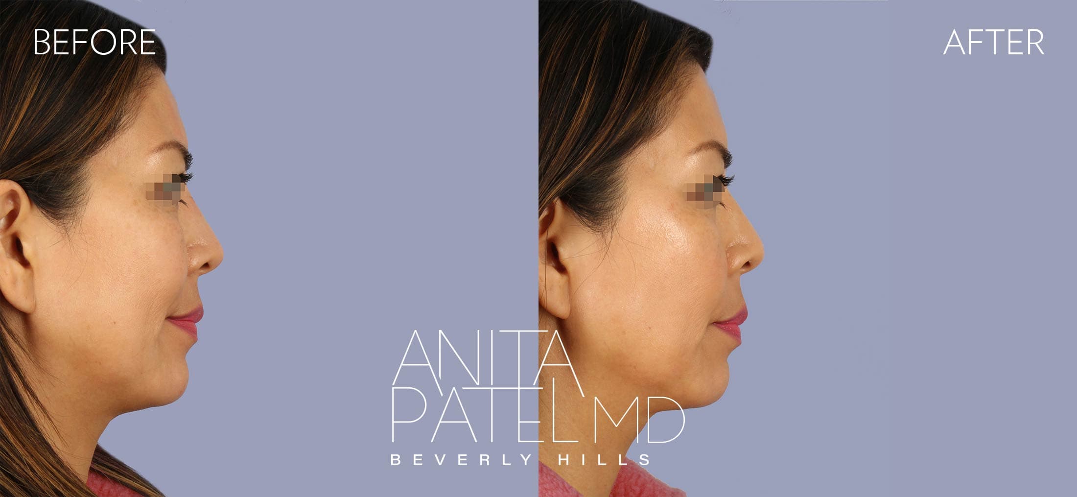 Liquid Makeover® before and after — Patient 5, photo 1 of 2 — Dr. Anita Patel, MD, FACS, Beverly Hills
