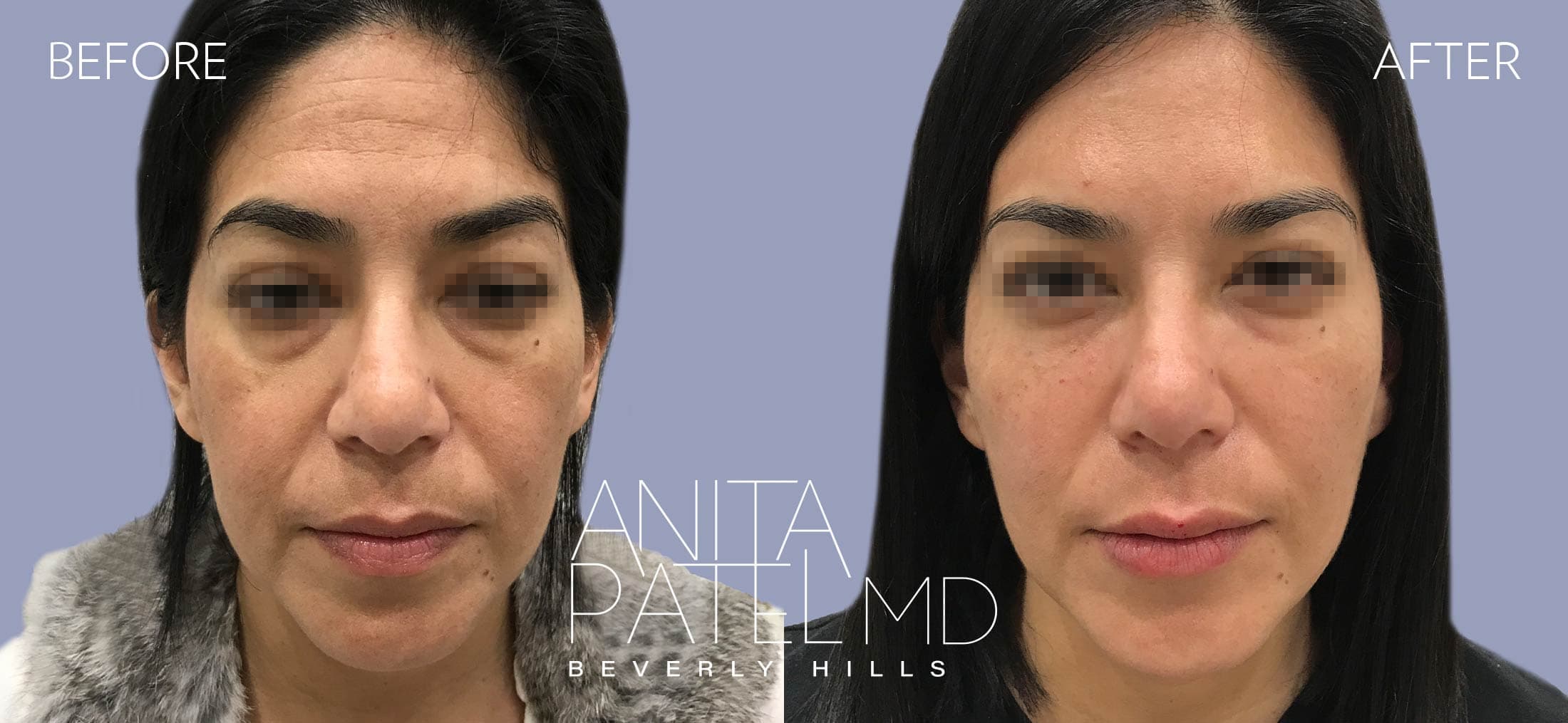 Liquid Makeover® before and after — Patient 6, photo 1 of 5 — Dr. Anita Patel, MD, FACS, Beverly Hills