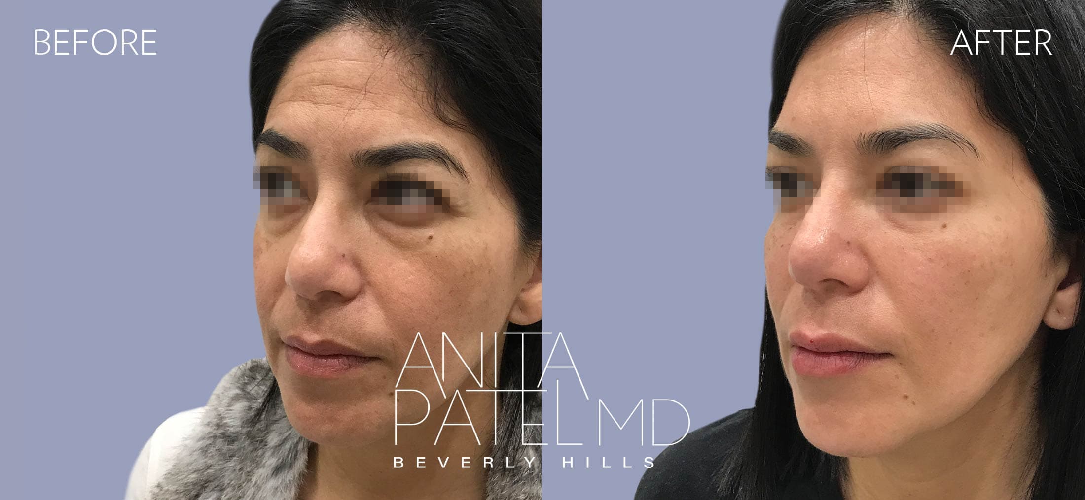 Liquid Makeover® before and after — Patient 6, photo 2 of 5 — Dr. Anita Patel, MD, FACS, Beverly Hills